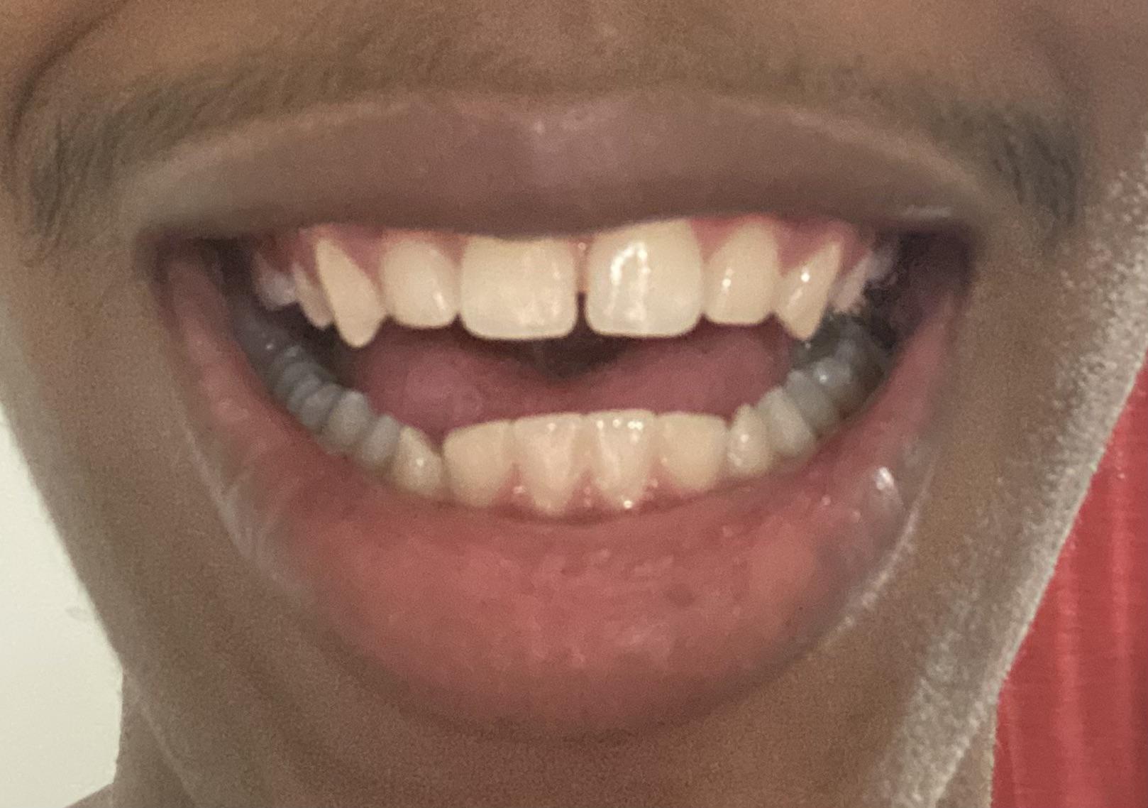 Cracked aligners?