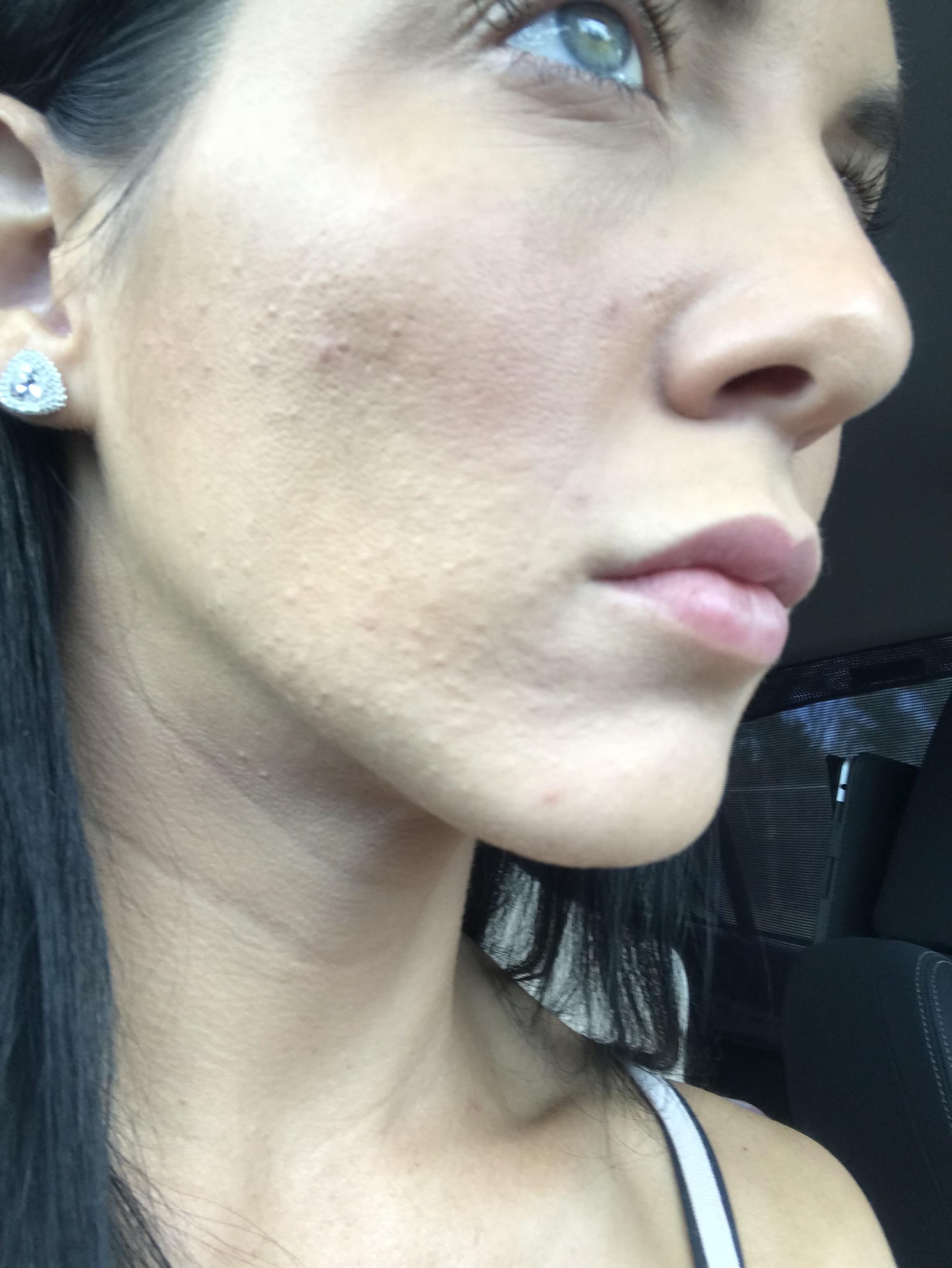 [acne] should I use AHA or BHA to clear up this congestion please? r