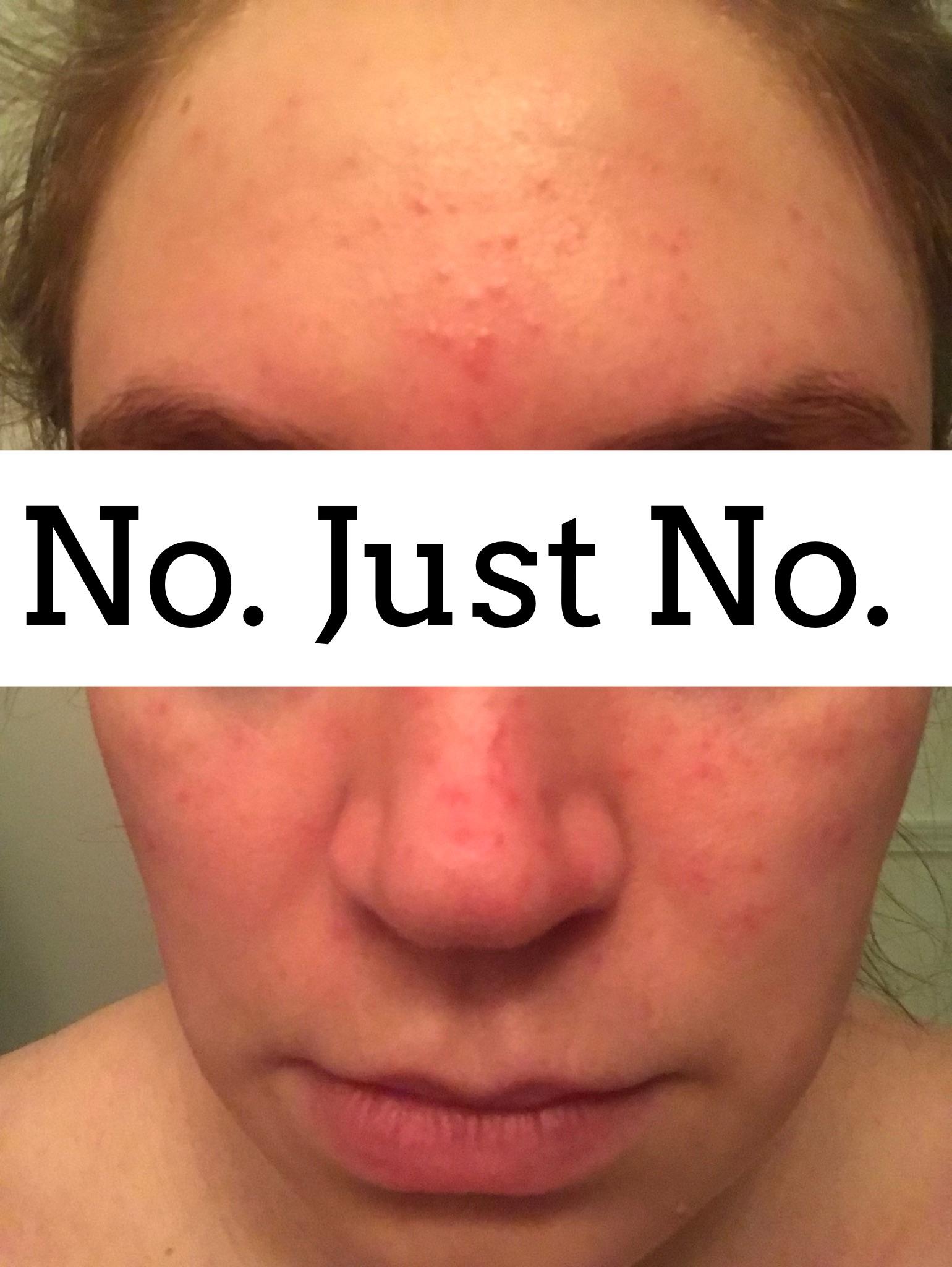 Reaction or rosacea outbreak after vegan GF diet, please help! Q in