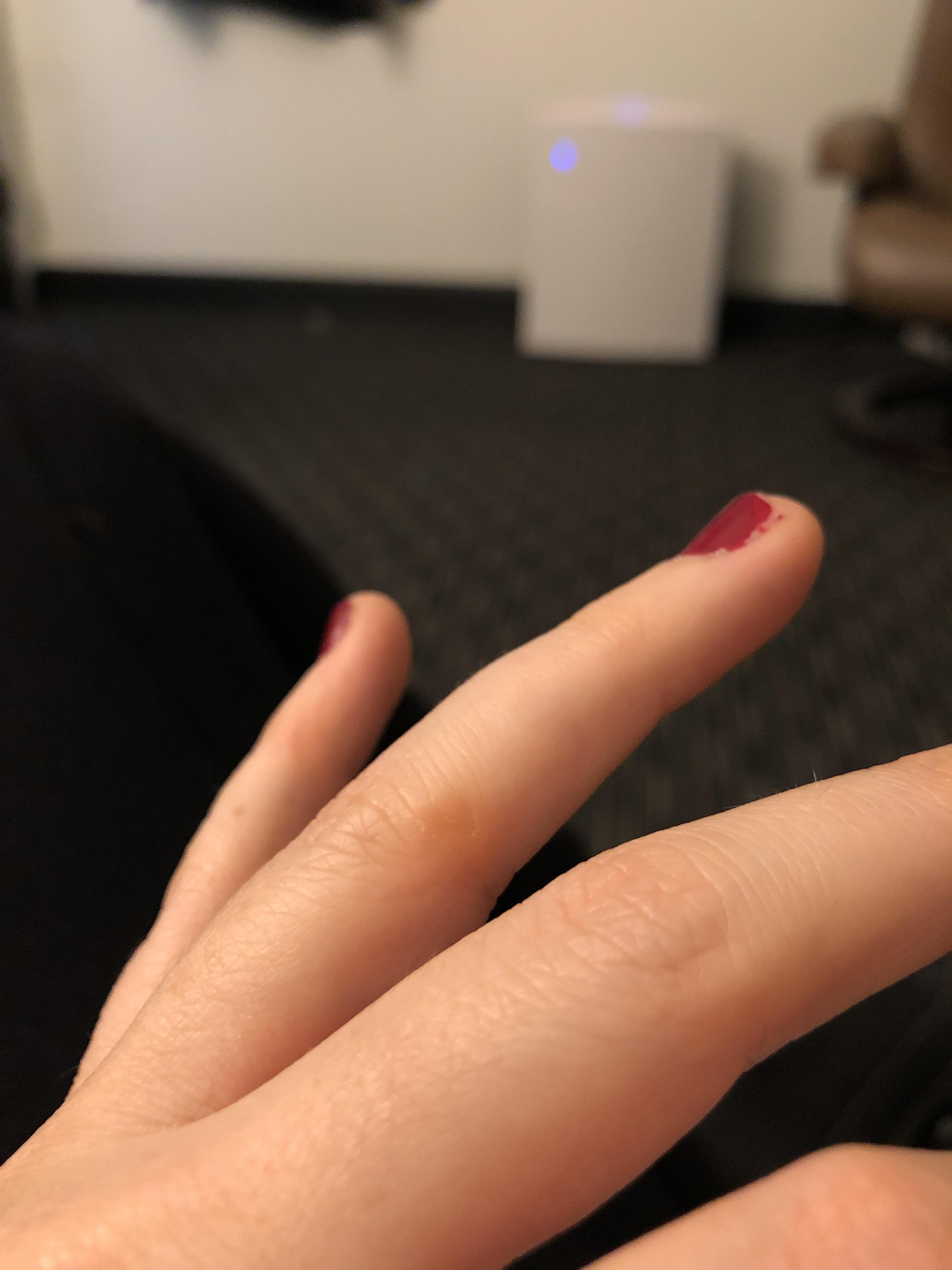Blister on ring finger!?! Help r/weddingplanning