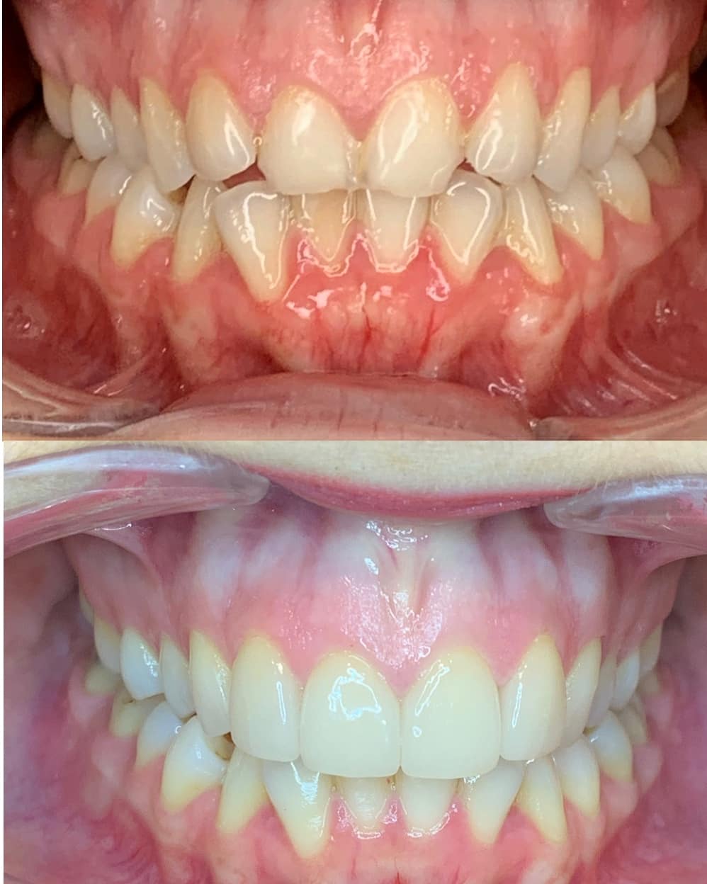 Bulimia eroded my teeth. Finally reclaimed myself and got