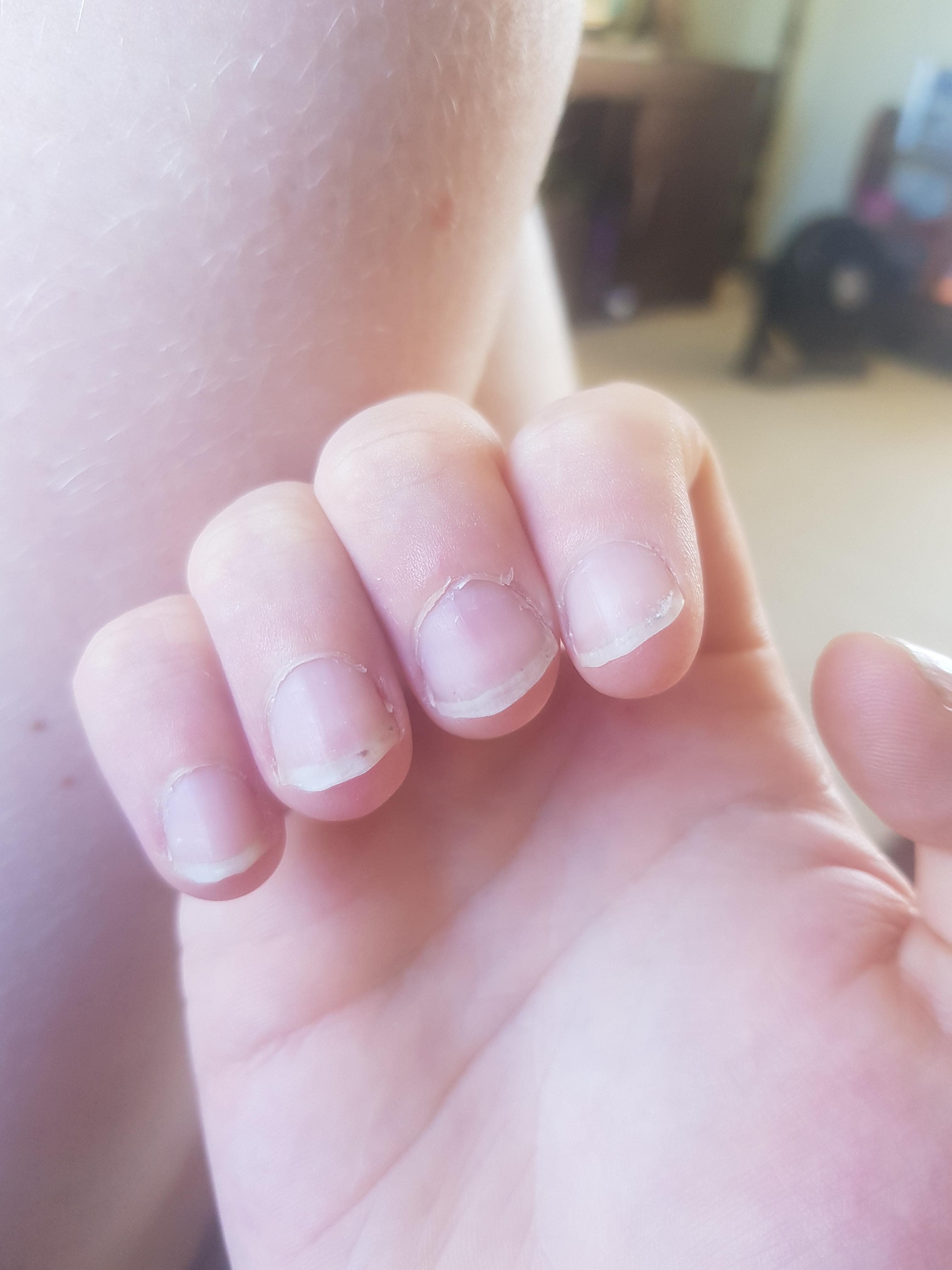 Have been fighting a battle with my nails my whole life and now I have