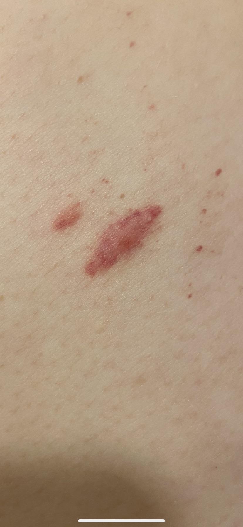 What type of rash is this? It is on my ribs. I've had a few thicks a month later so i am