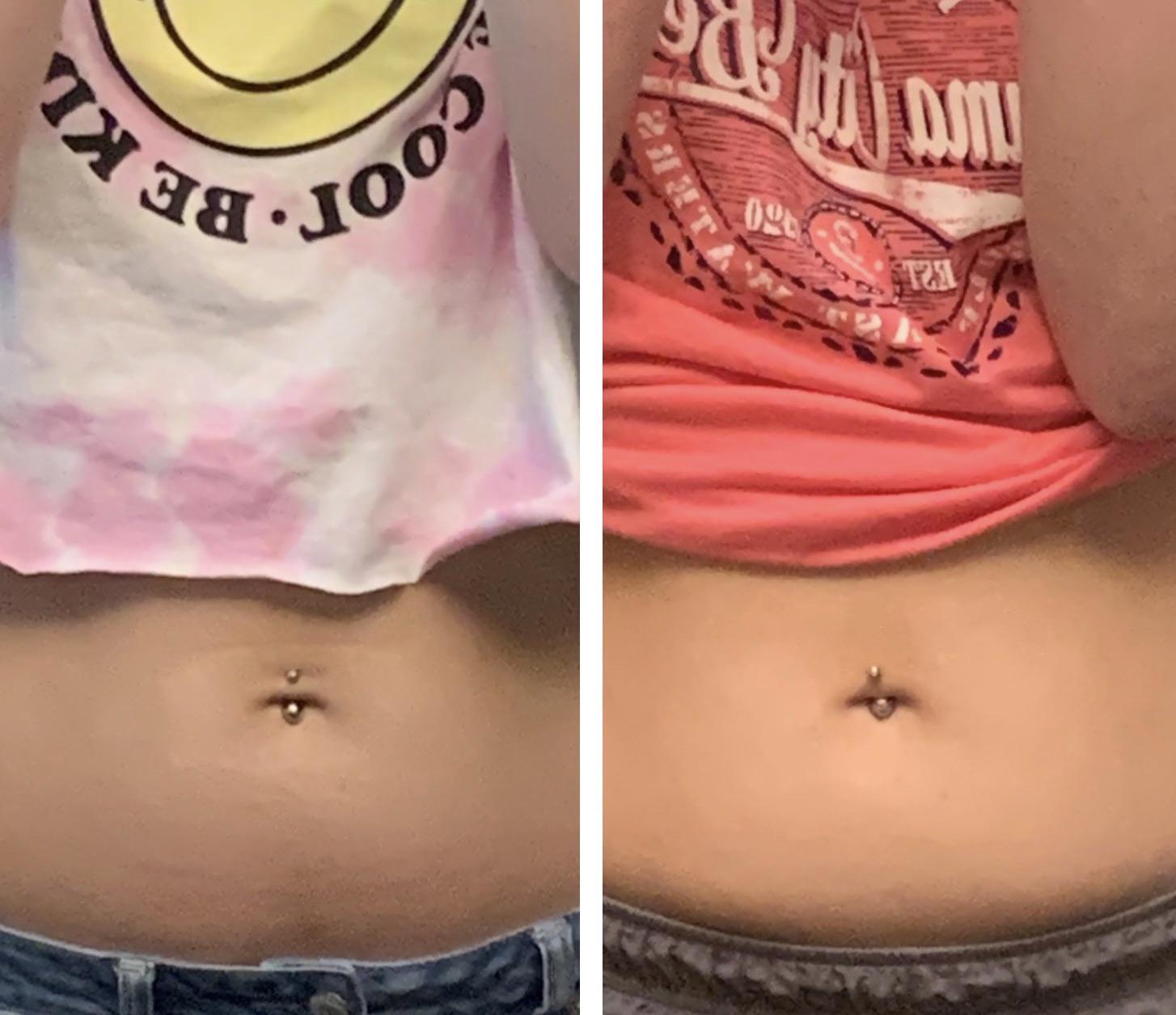 Week old navel piercing starting to look crooked? r/PiercingAdvice