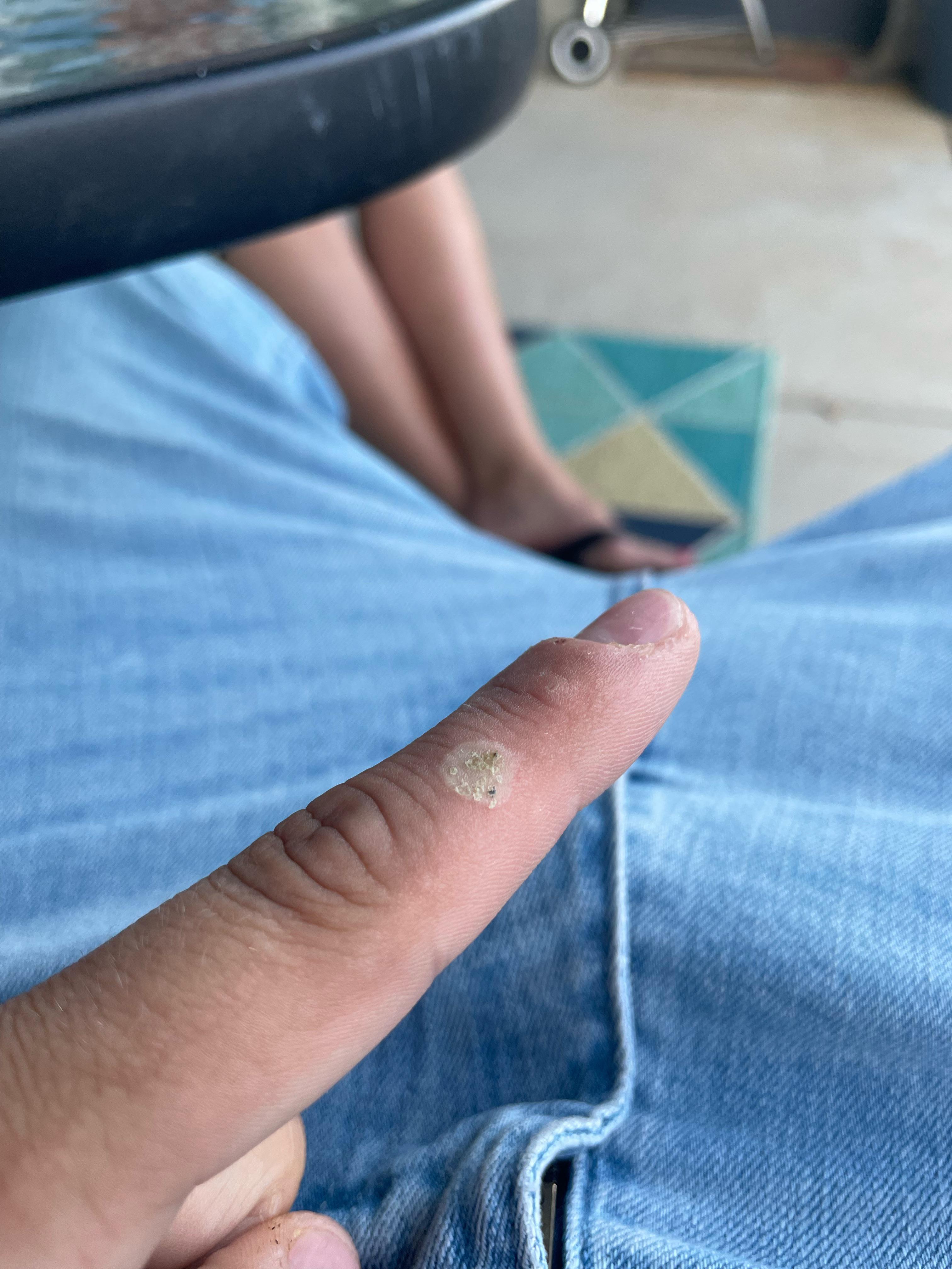 Does anyone know what kinda burn this is? I don’t feel anything when I