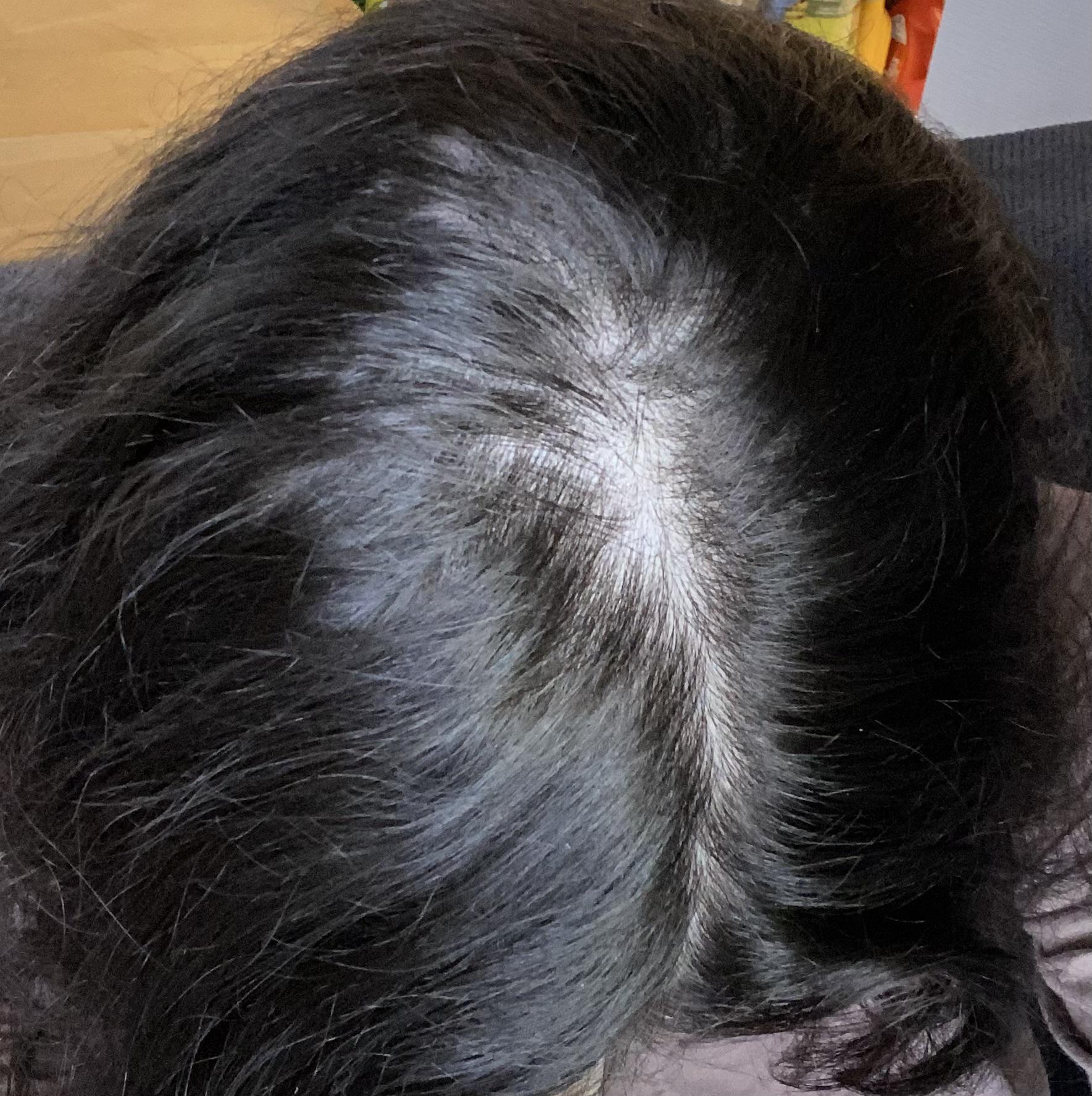 How to stop balding at the top of my head? I’ve been noticing a lot of