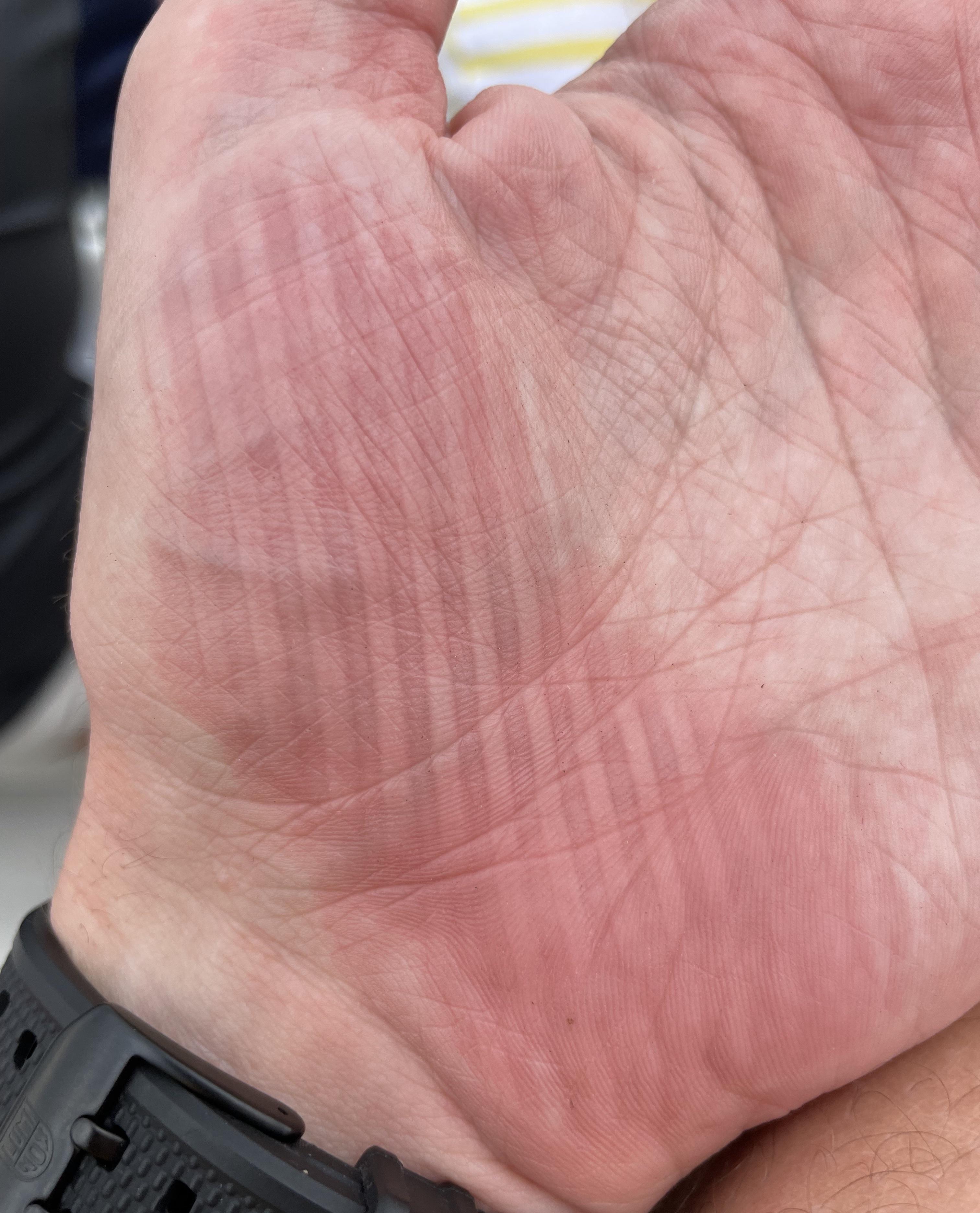 Does anyone else get imprints very easily on their skin? This is from