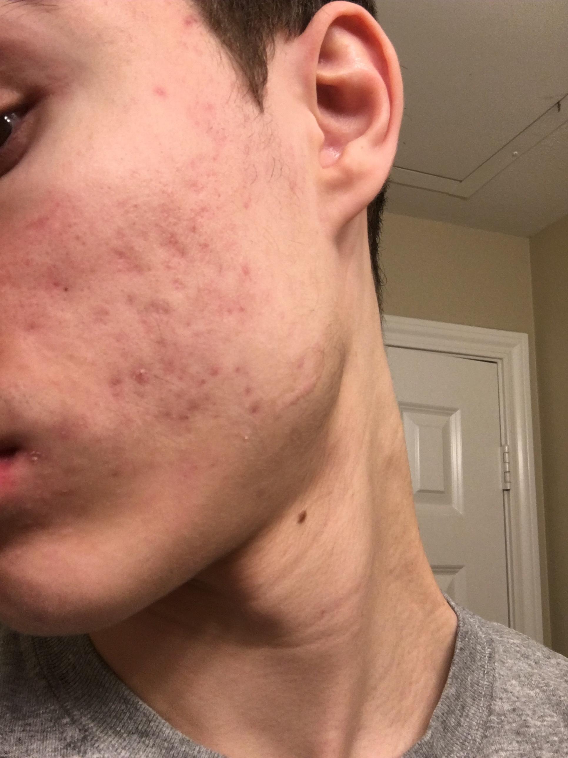 How to fade and improve the scarring acne