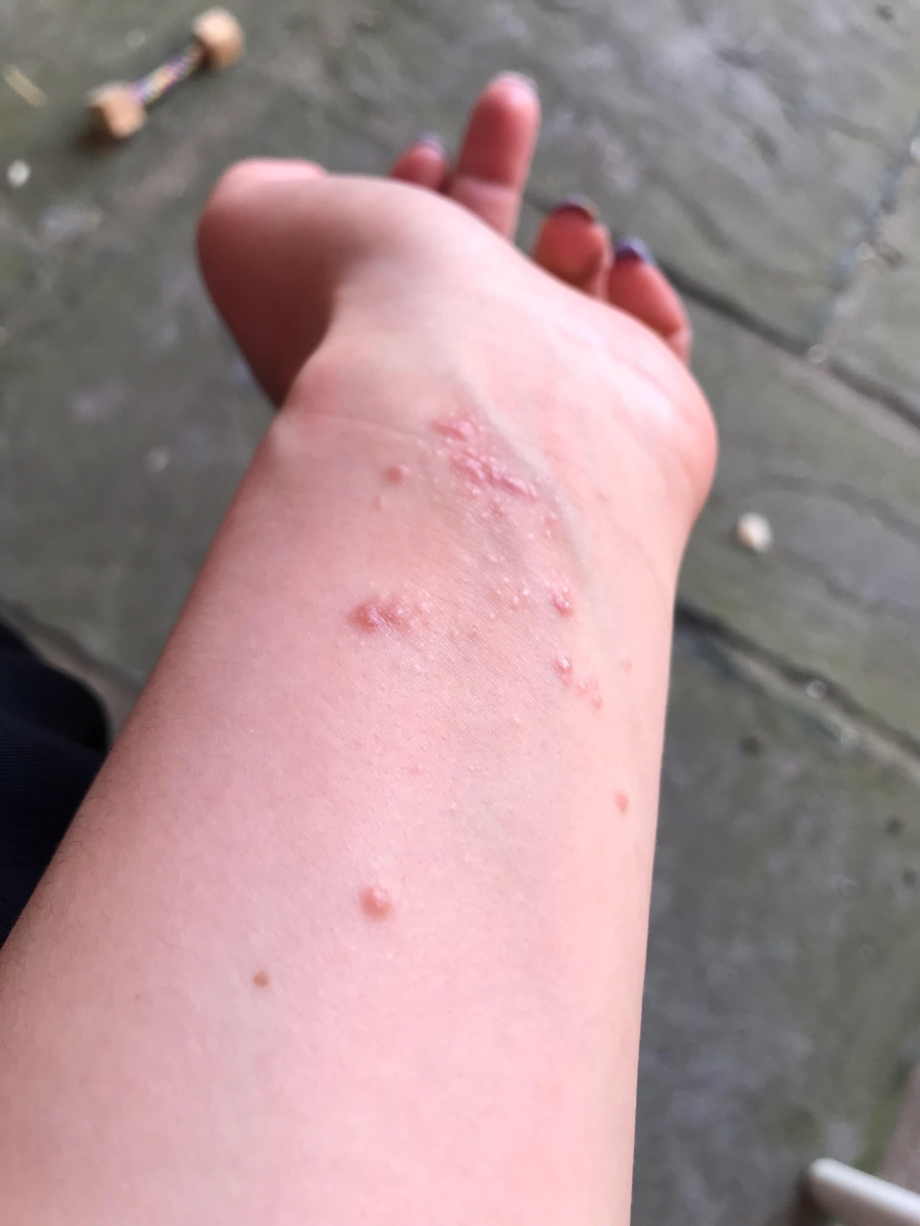 What is this itchy rash on arms and legs paired with tiredness and