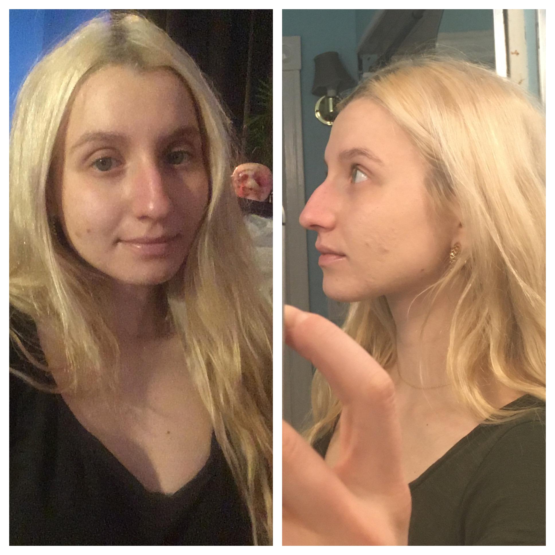 got brutally made fun of when I was a kid for my nose. Some days I feel