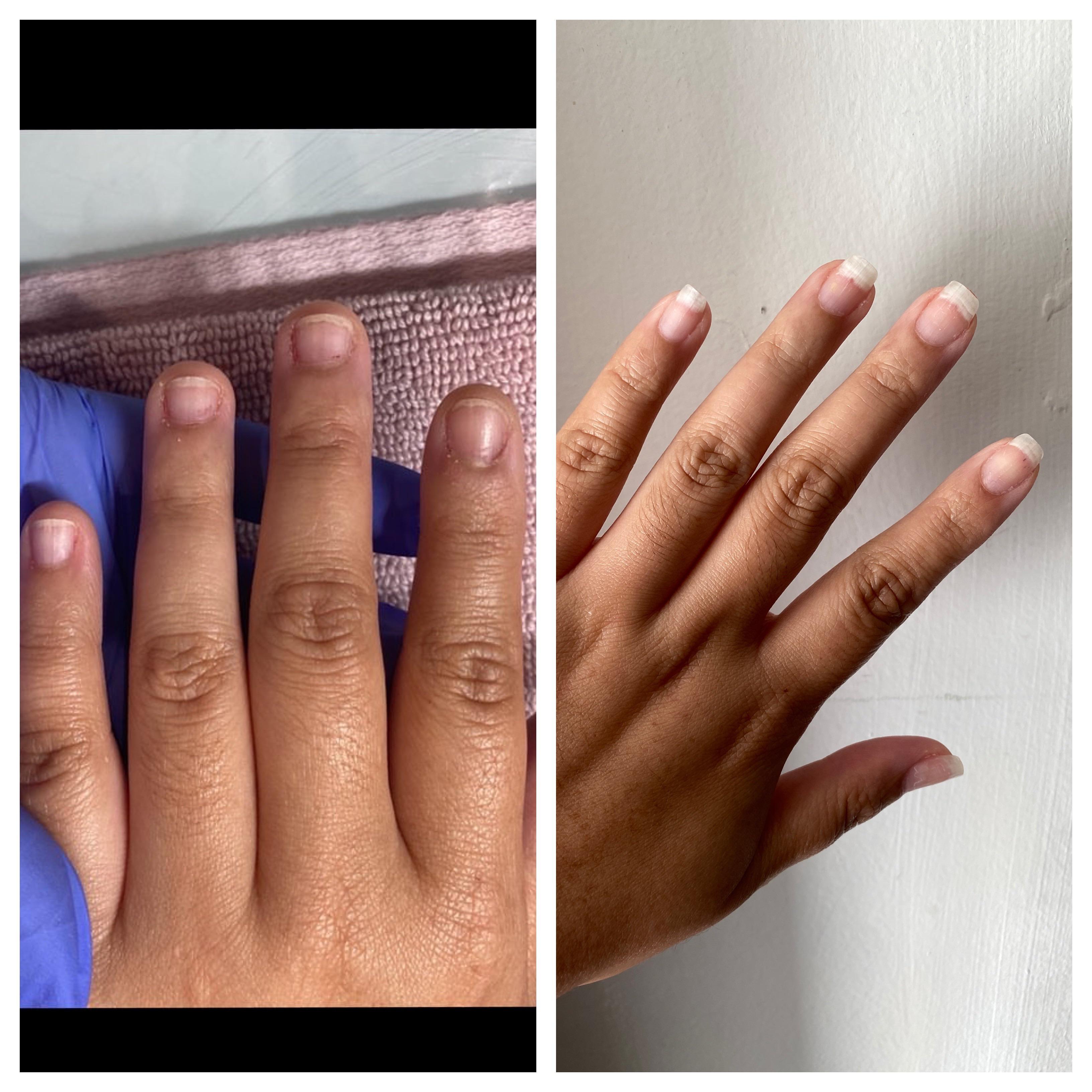 New nail growth progress record! nailbiting