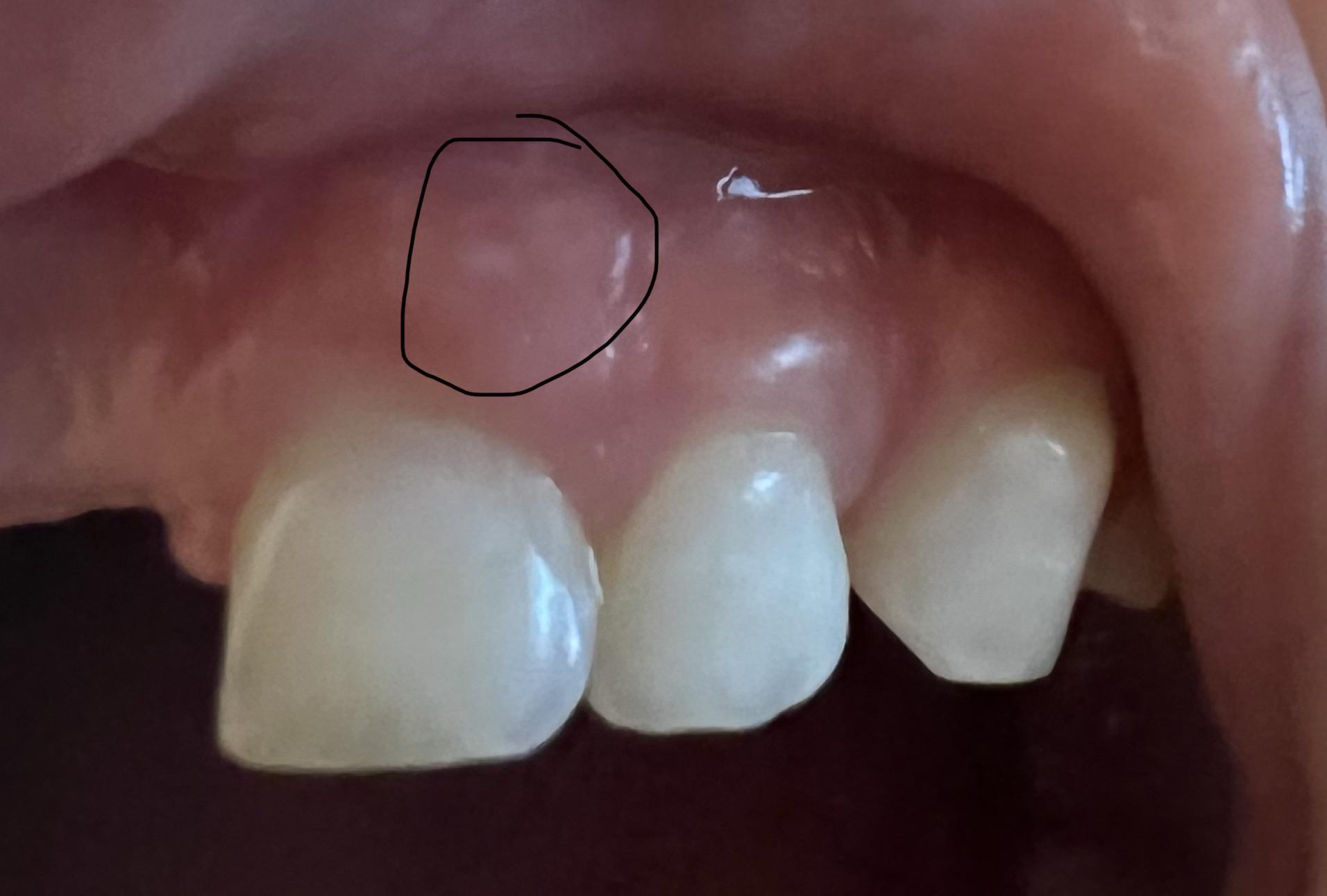 White spot on gums? Details in comments. r/askdentists