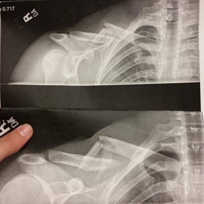 ISO advice lifting back from surgically repaired clavicle r/weightlifting