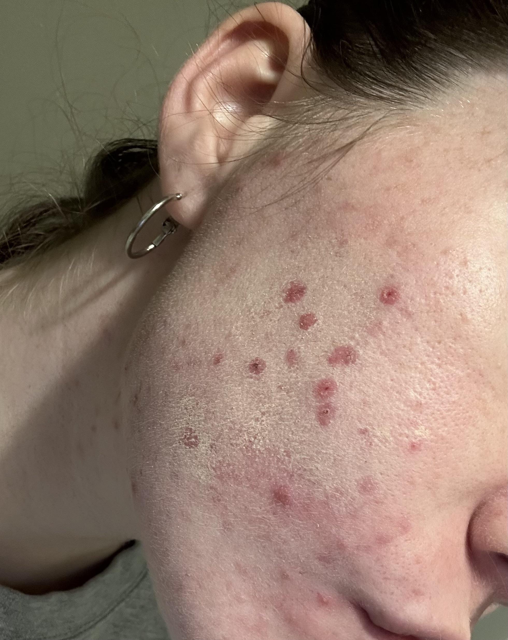 Why does makeup look like this on my acne prone skin? [Acne] r