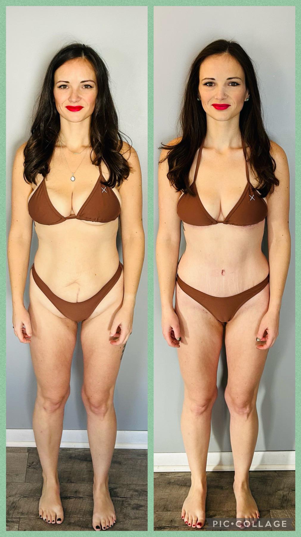 Before and after tummy tuck and breast lift after loosing 70lbs! r