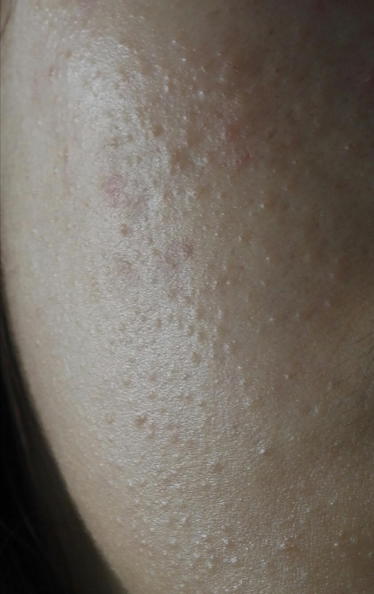 [skin concerns] how do i get rid of tiny bumps r/SkincareAddiction