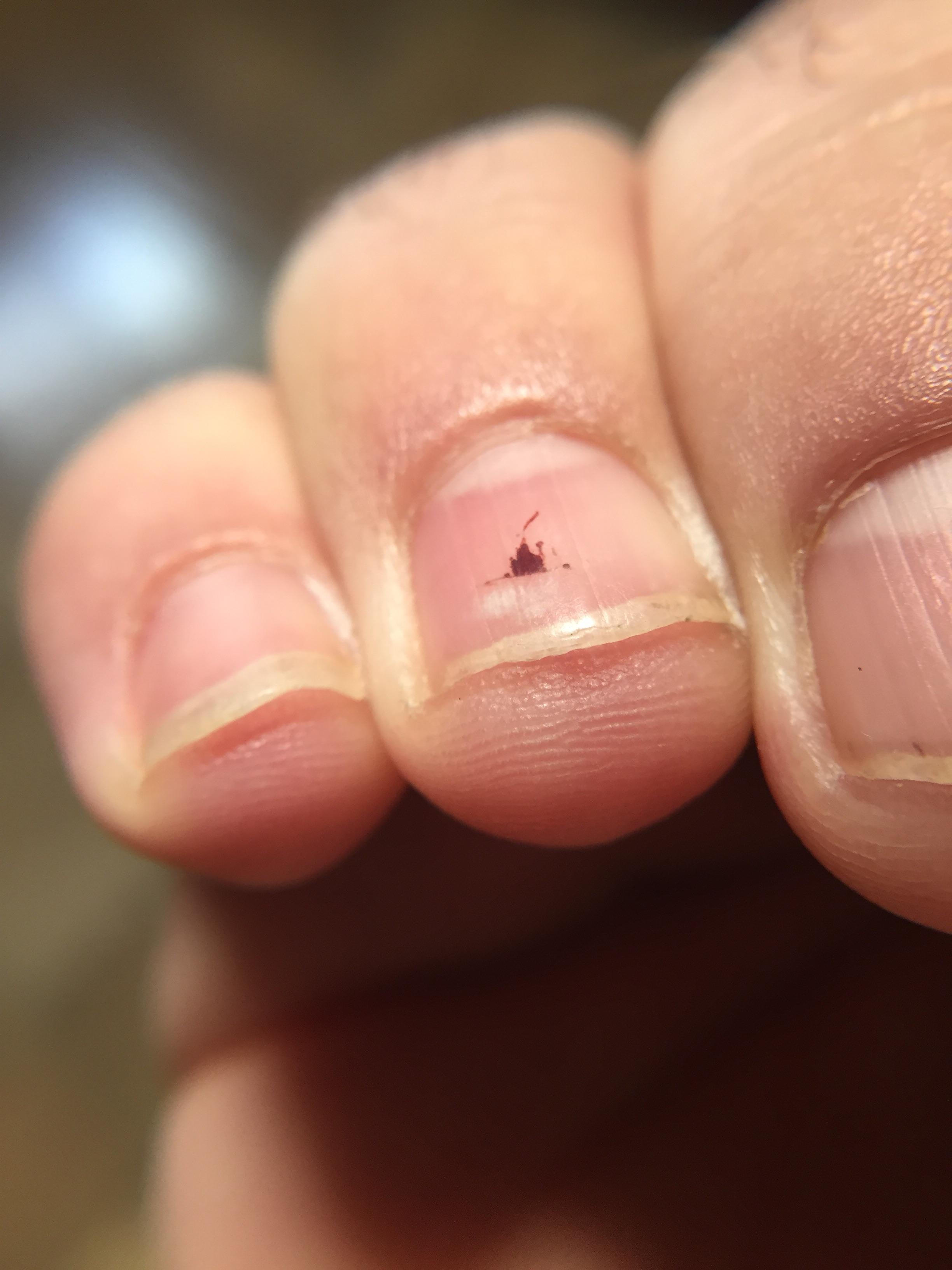 My blood blister under my fingernail looks like Disneyland's Castle
