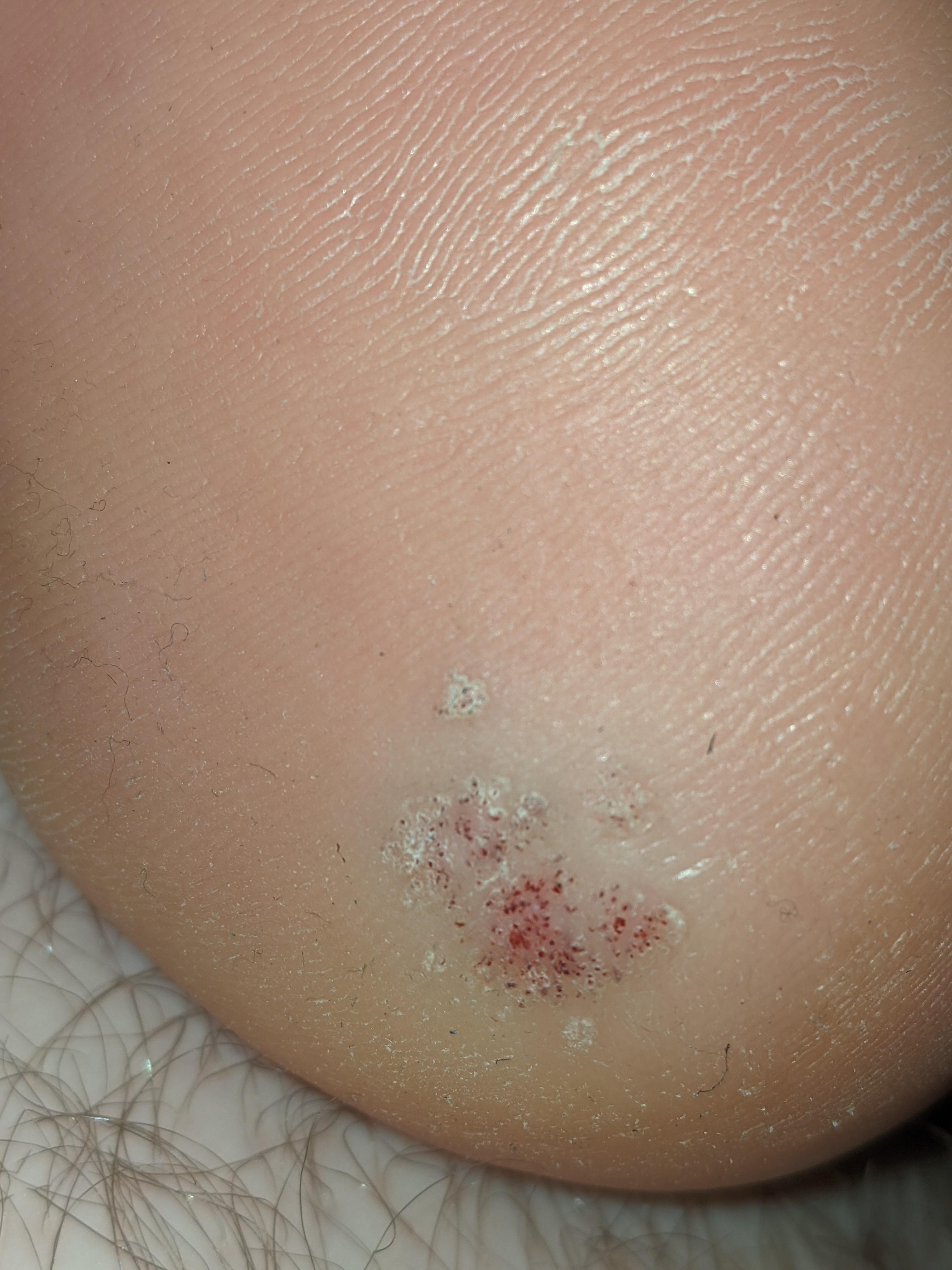 Heel callus confirmed by foot doctor, been cut out, came back, and is ruining my life. r/skin