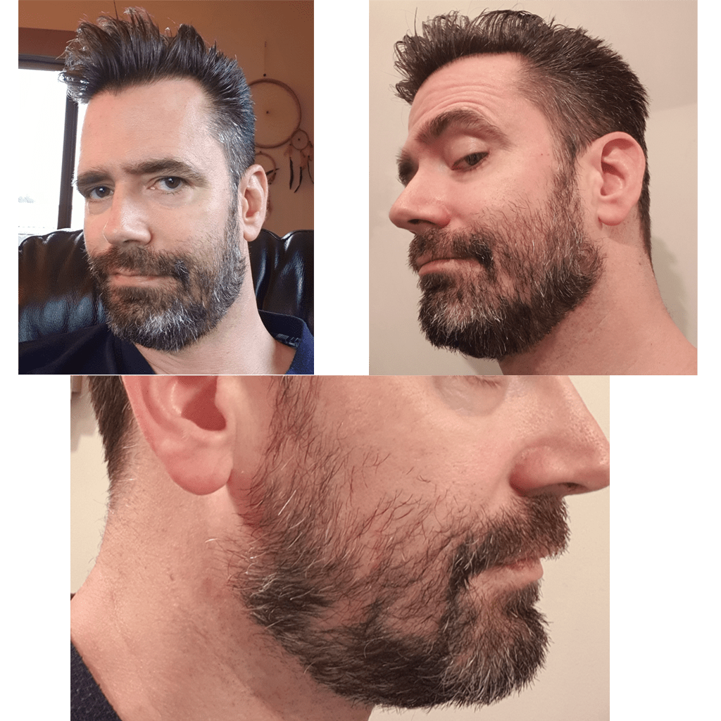 First time beard 1 month. I am concerned about the bald spots. Should