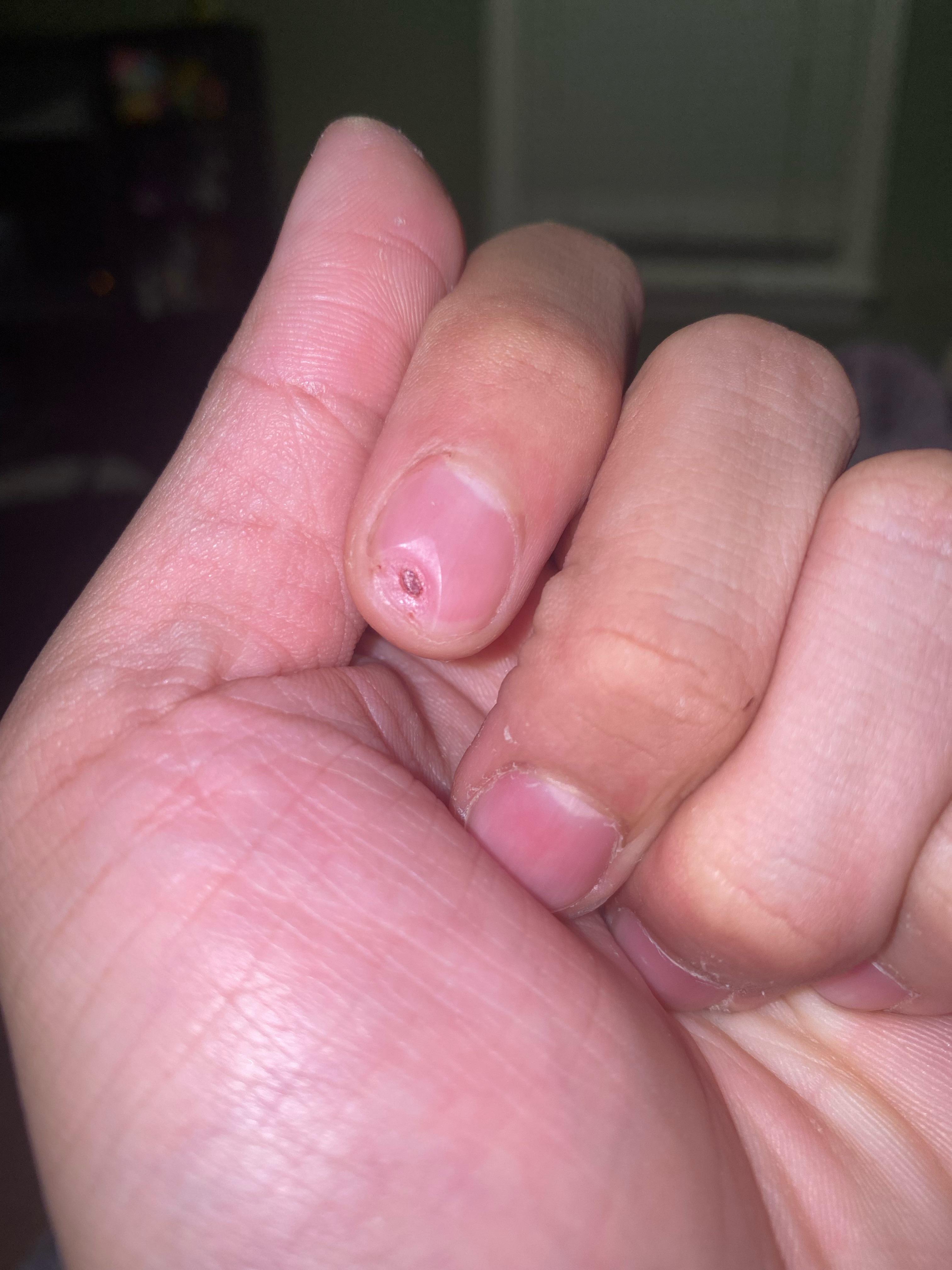 I cut my part of my fingernail off r/medical