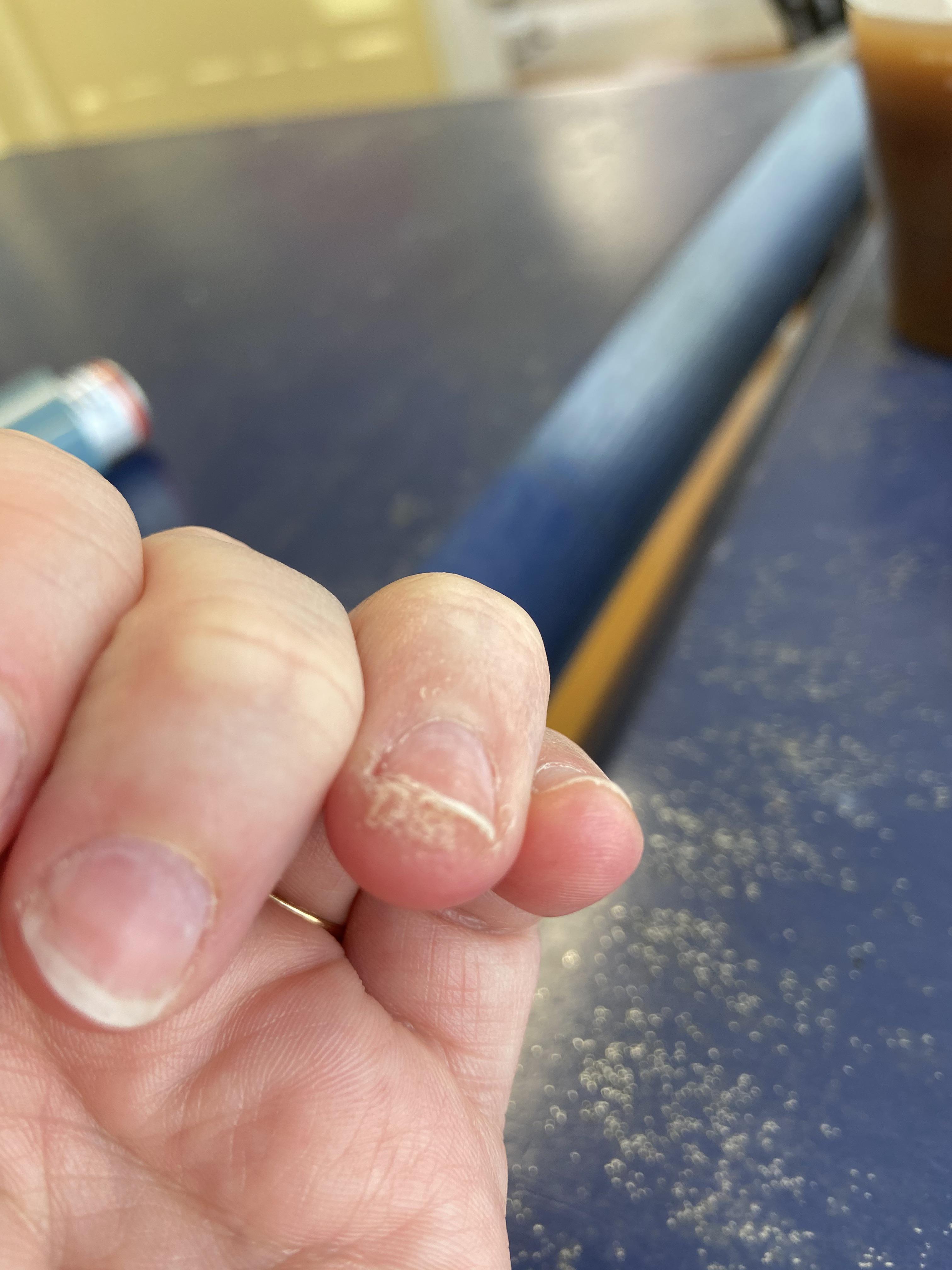 Update HEMA allergy if anyone cared to know 😂 r/Nailtechs