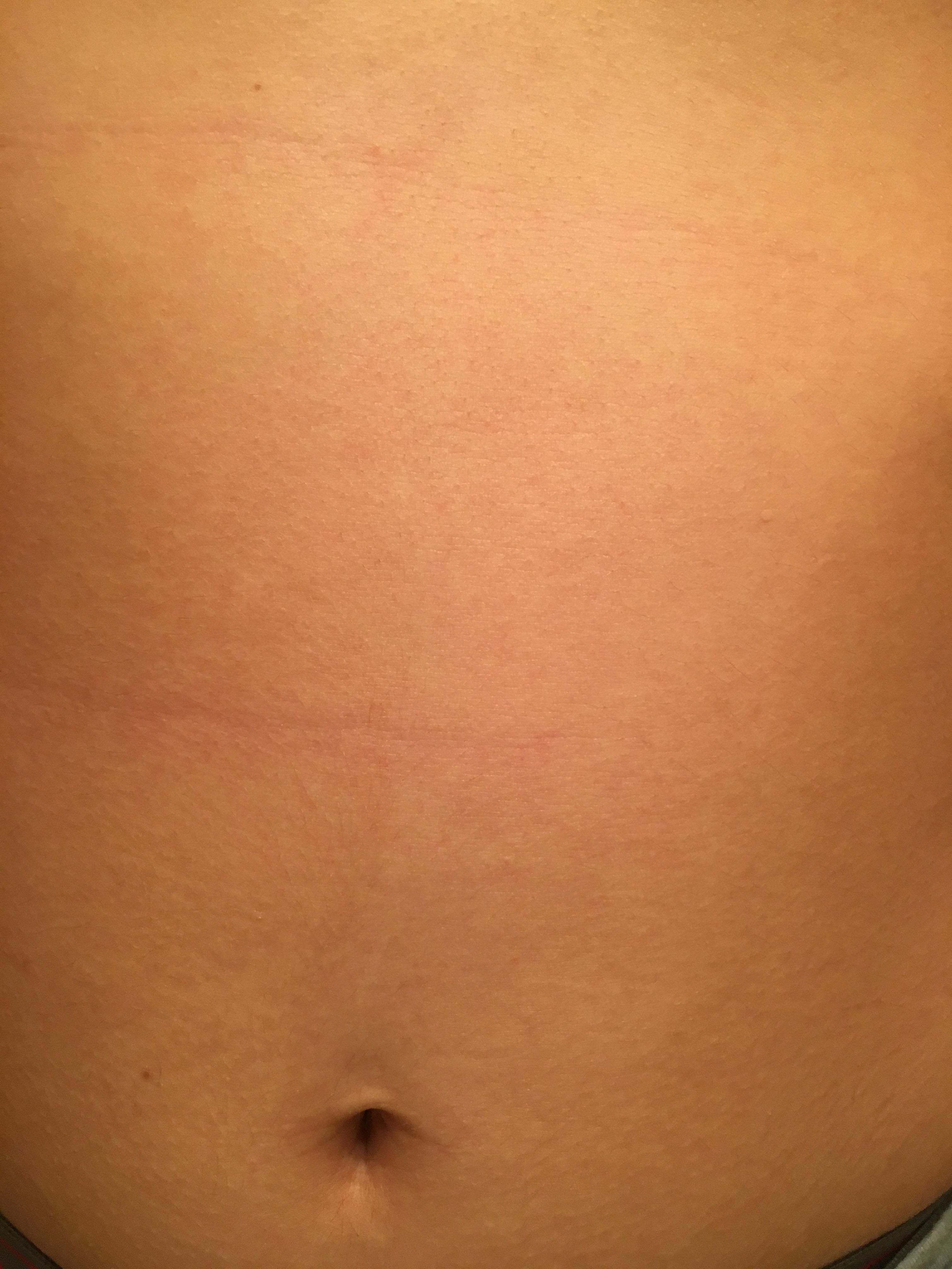 Starting to get these lines on my stomach. Is it from the fat? Or diabetes? r/MedicalHelp