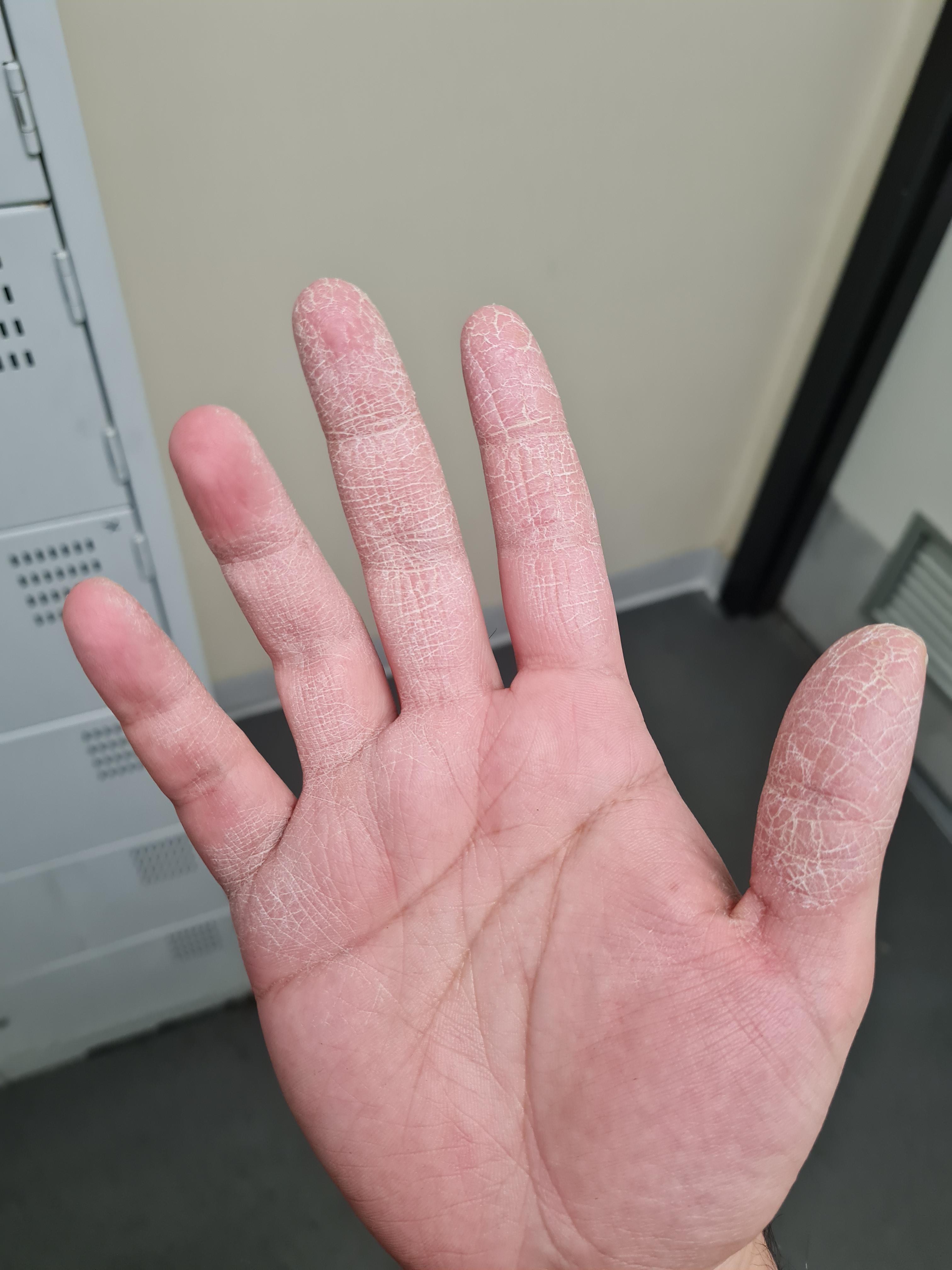 Extremely dry fingers for the past few months and no idea why cause my