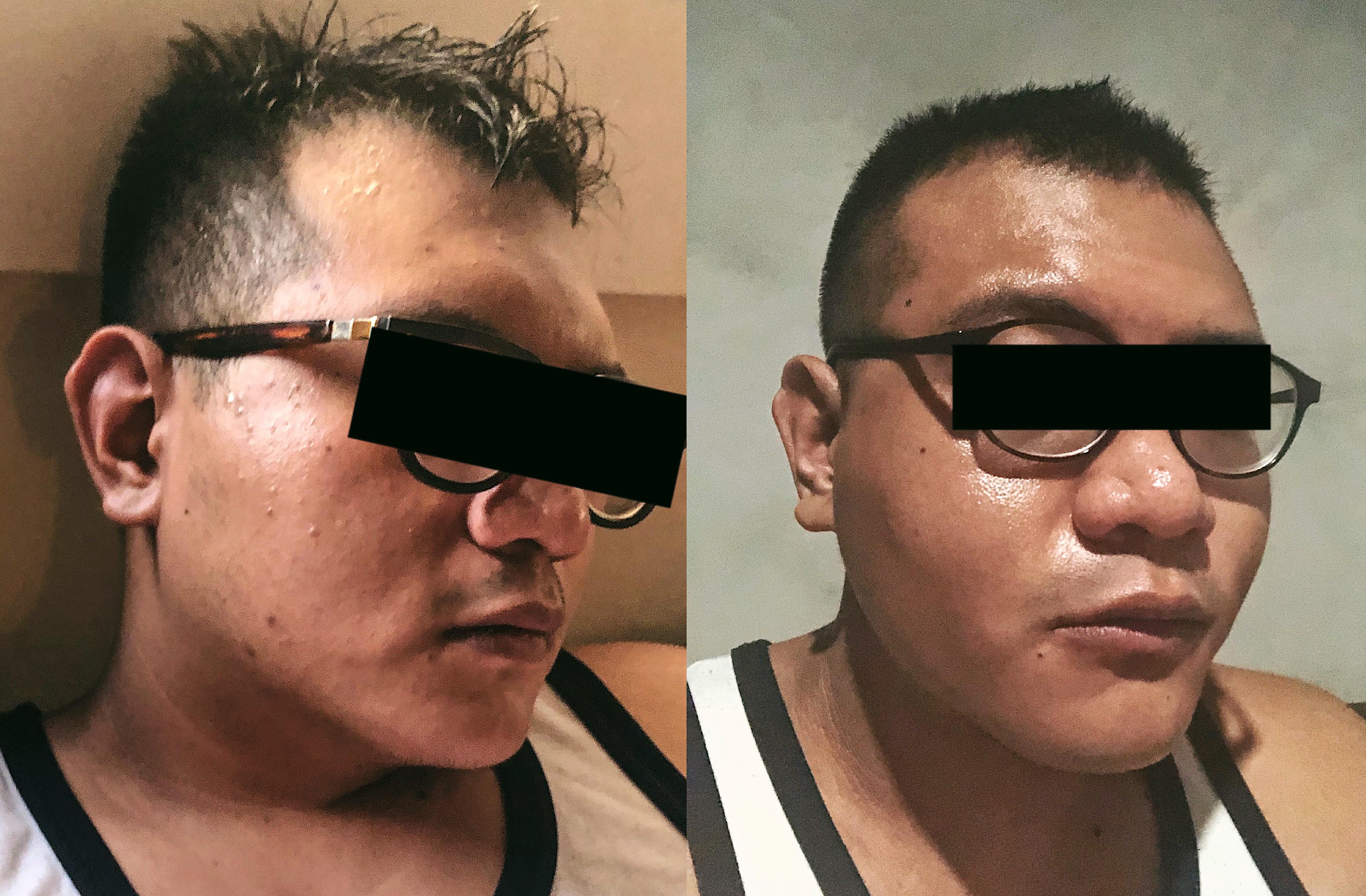 [B&A] 2 months using vitamin C and retinol consistently r