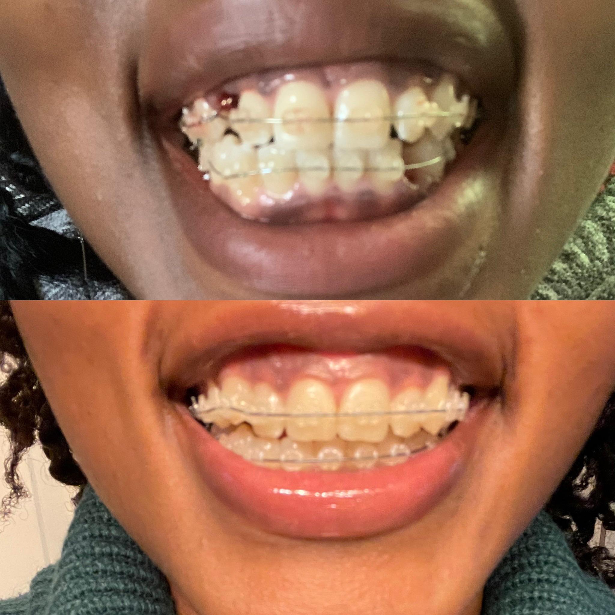 June Top right after two extractions + 1 impacted canine chain