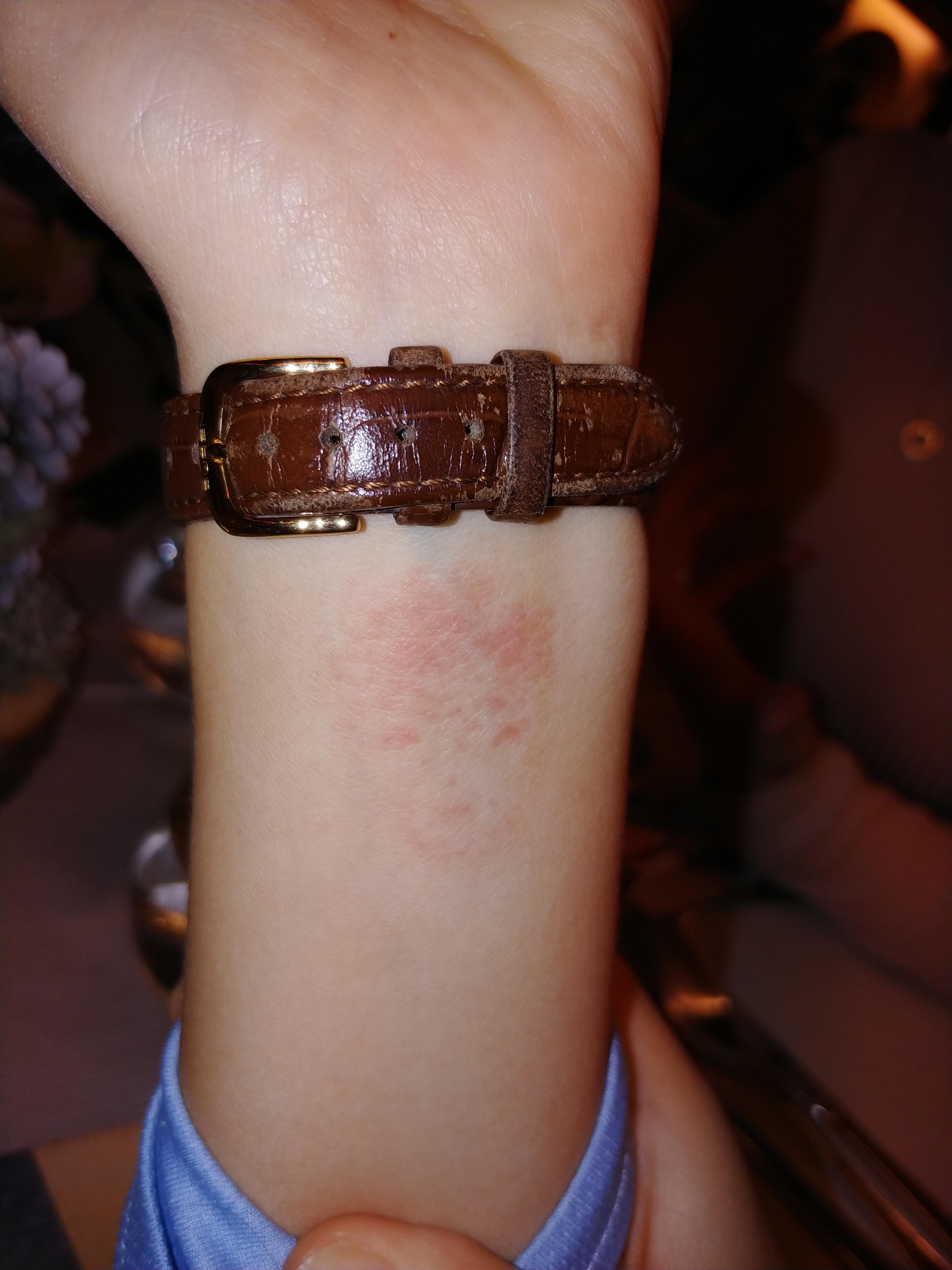 My Friend Has A Watch Rash In The Shape Of A Human Face