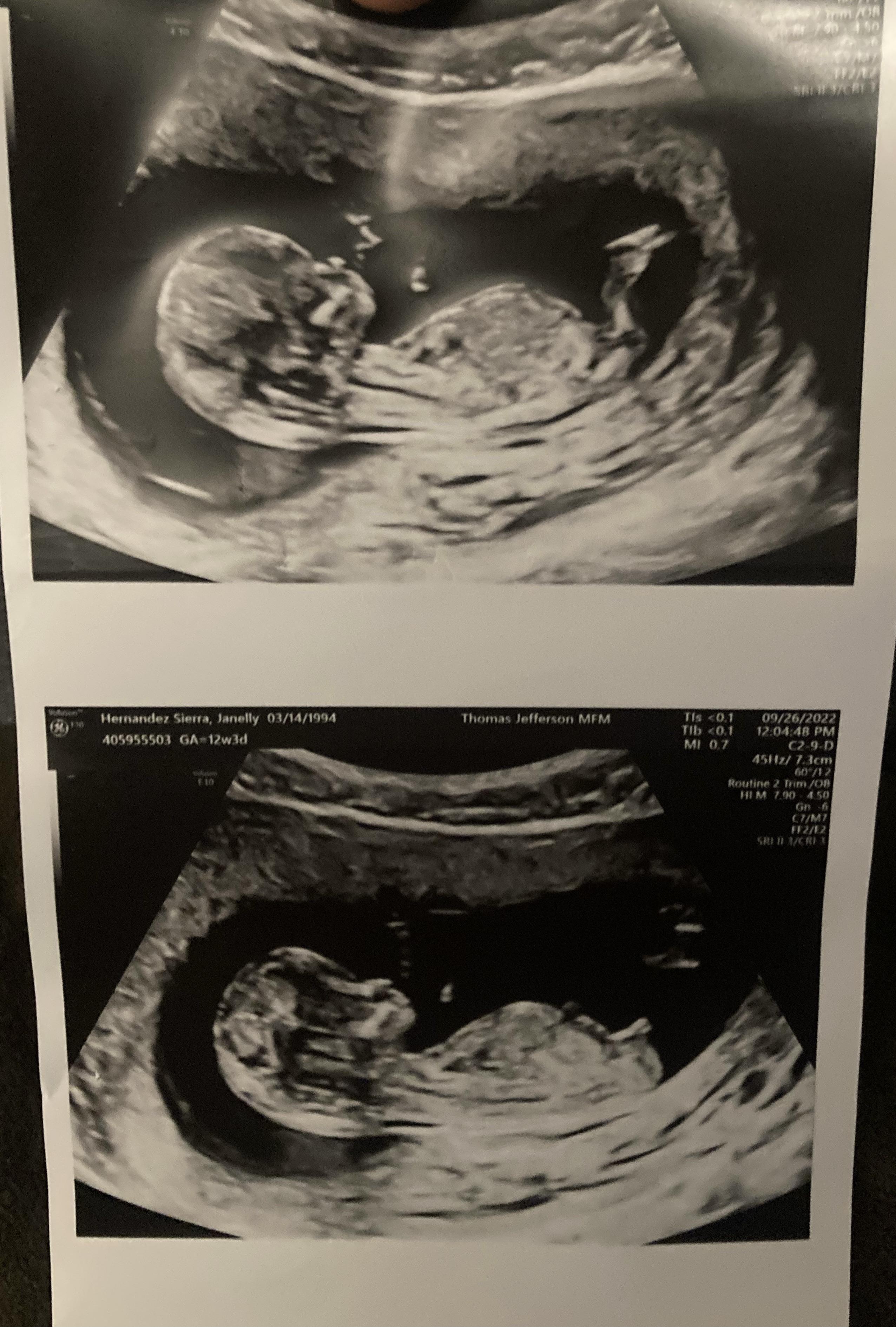 12 Week Ultrasound Gender Boy