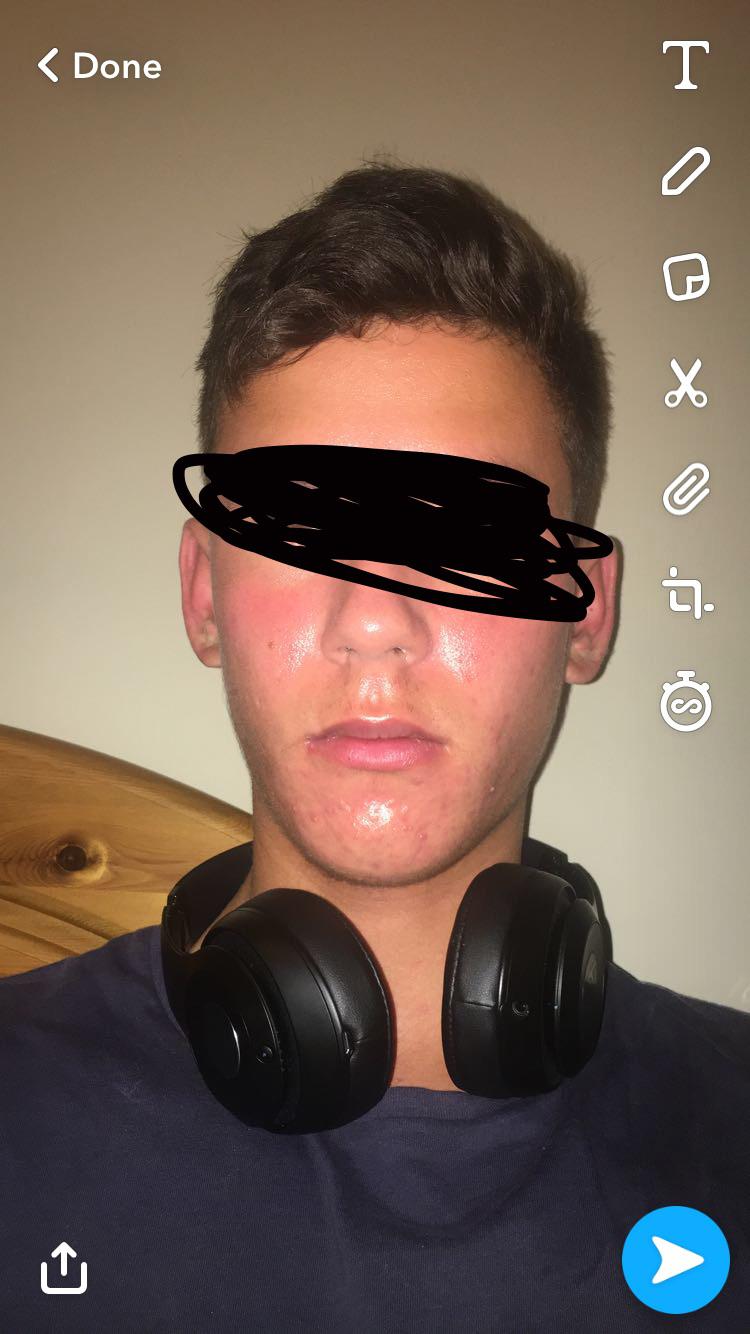 On Duac for 2 weeks, skin is extremely oily and red, any creams to