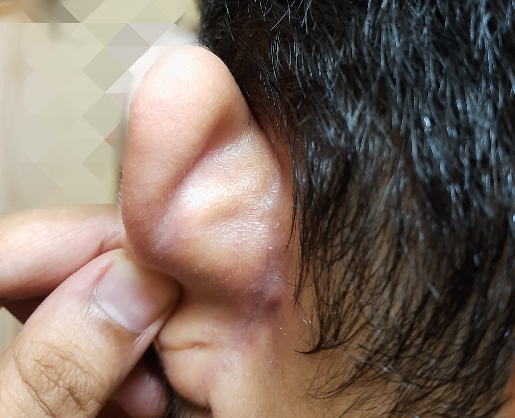 Bump behind ear. No itch. Pains when touched. What could this be