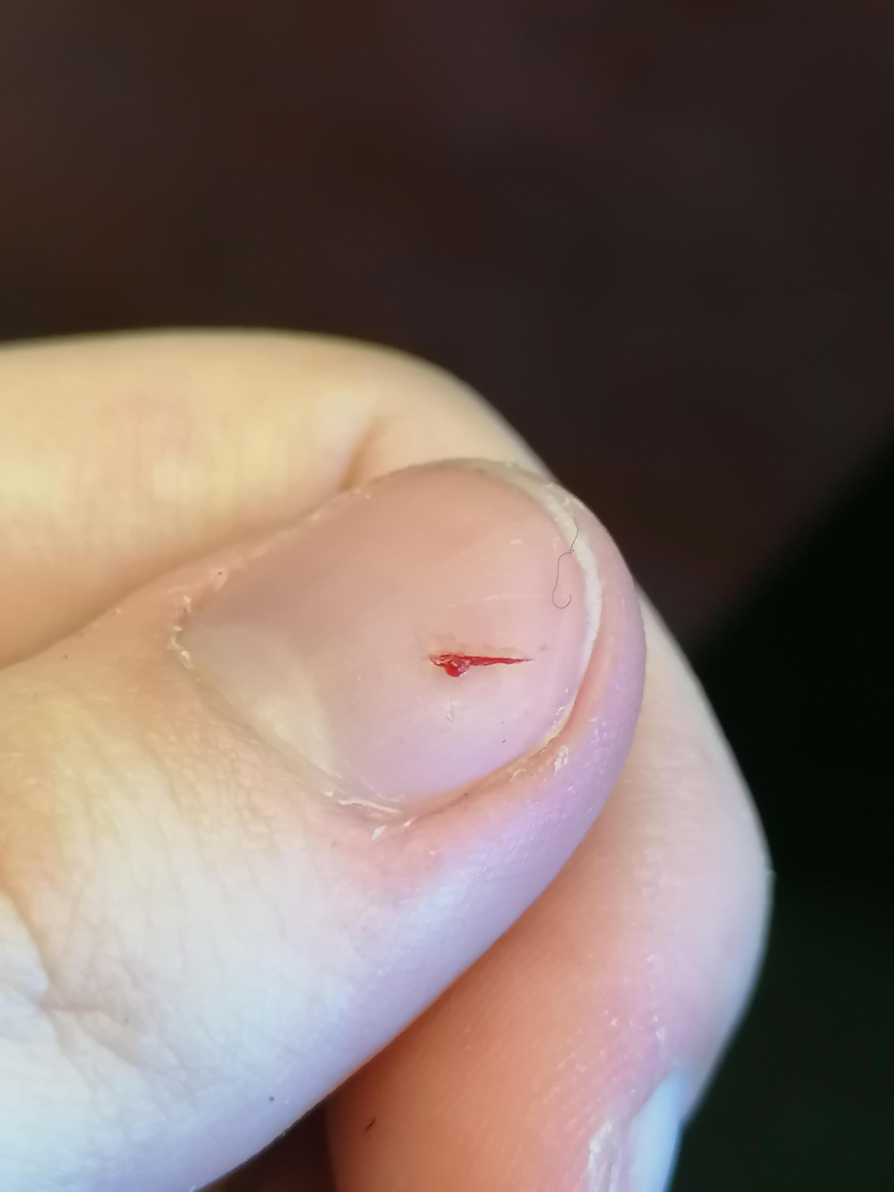 I accidentally stabbed a hole in my nail r/Wellthatsucks
