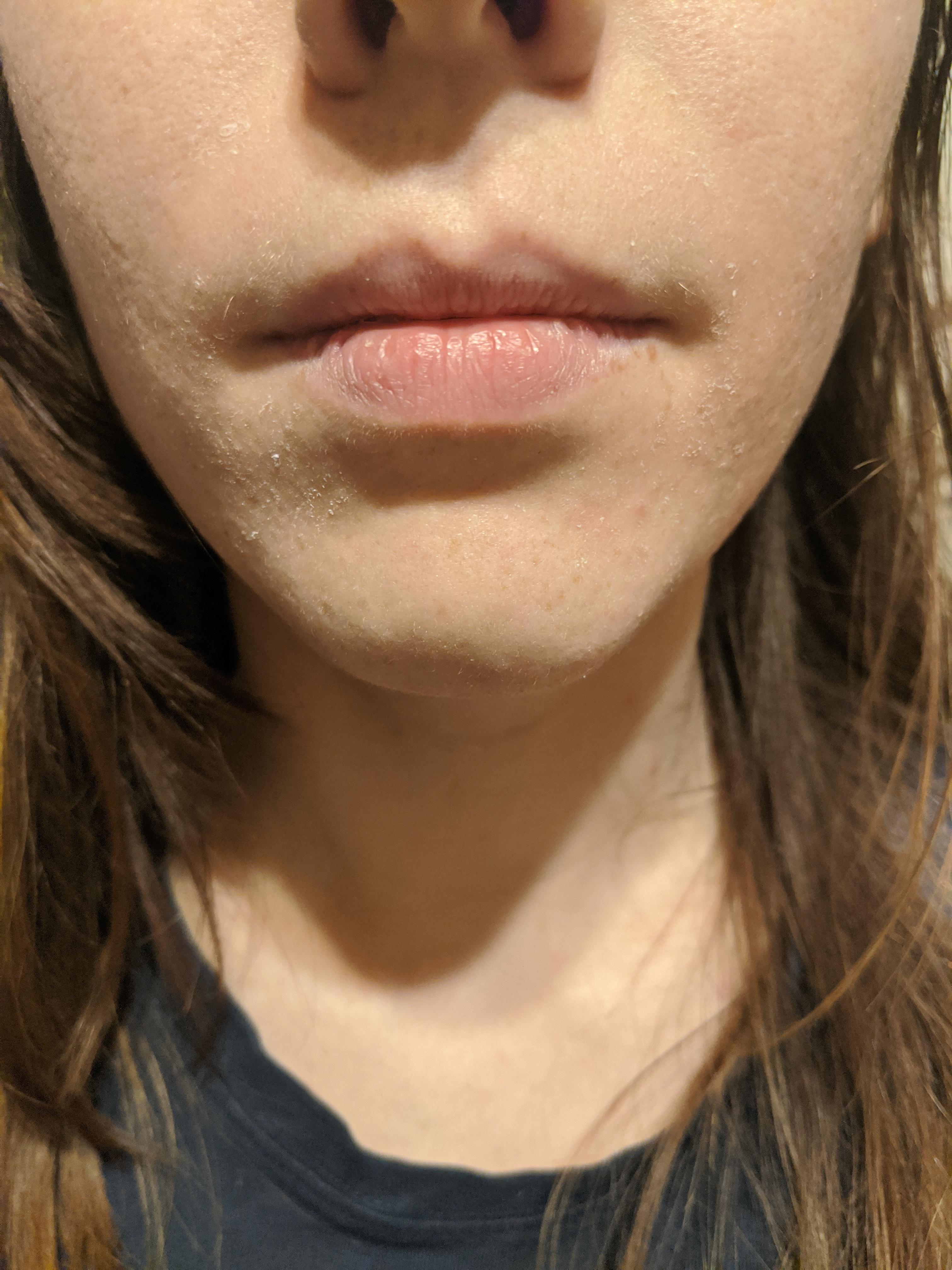 I've been using 0.02 tret for a week and I'm experiencing some peeling