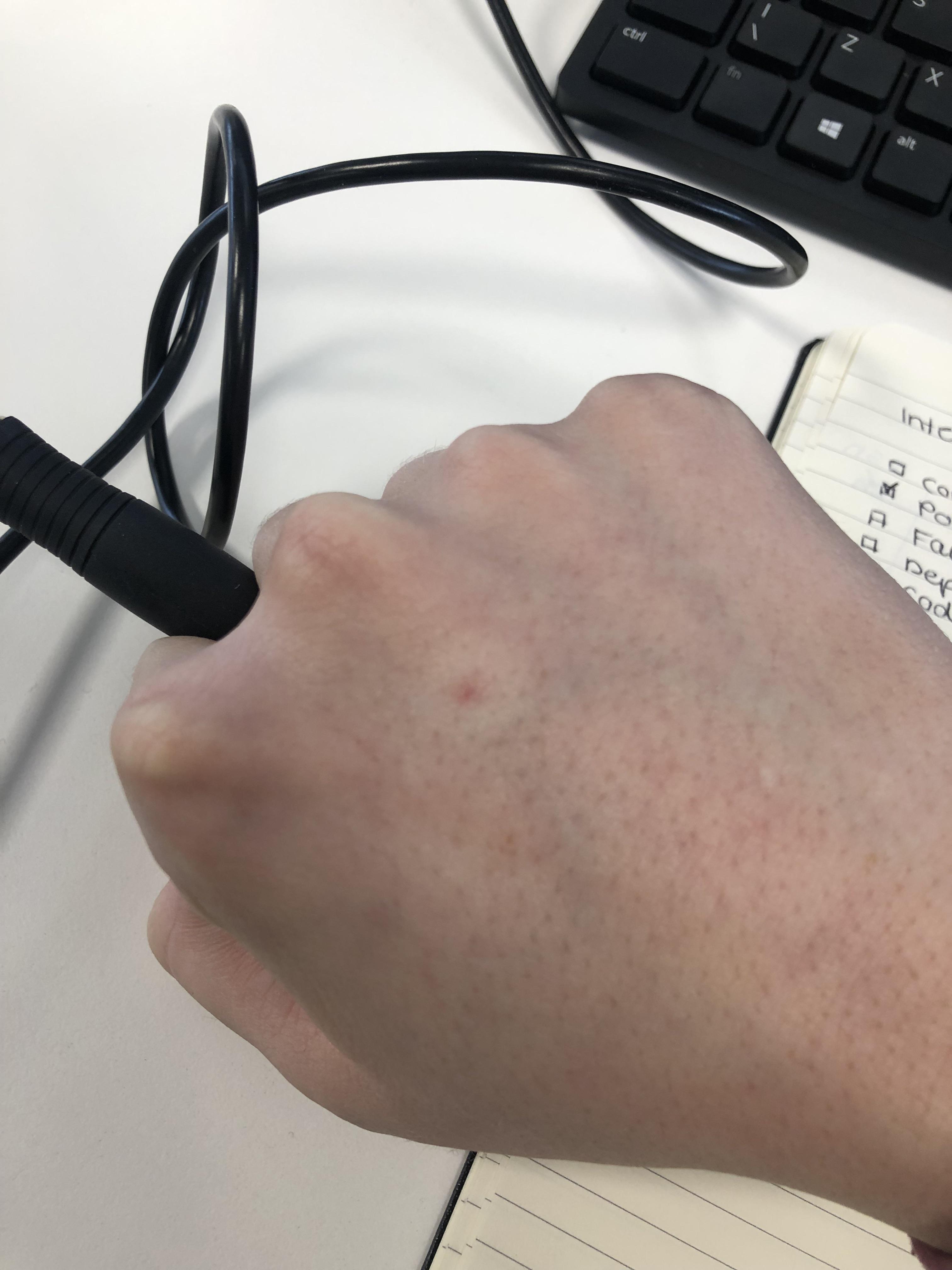 White ring around red spot Should I get this checked? r/Melanoma