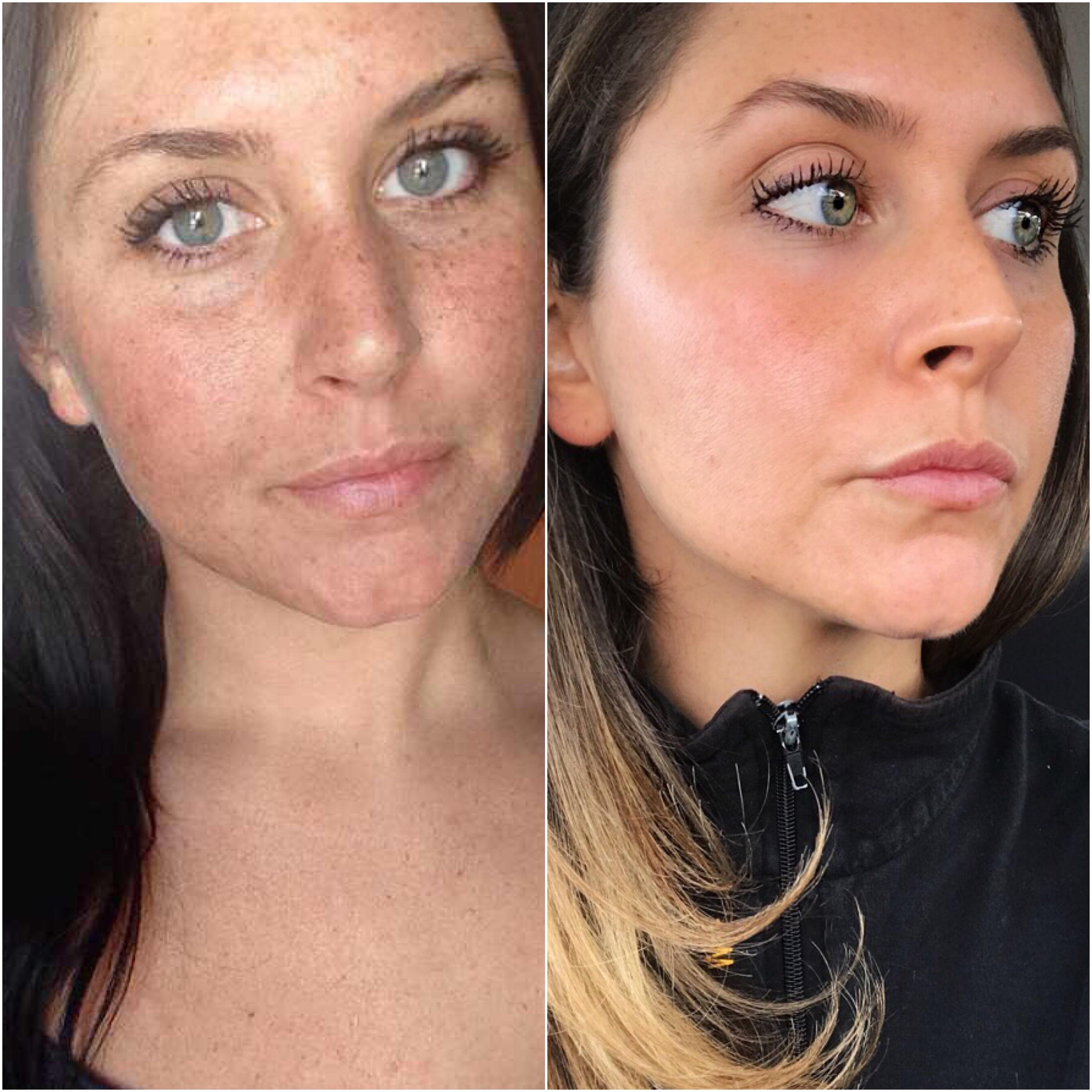 After using sunscreen and a vitamin c serum every day most of my freckles vanished r