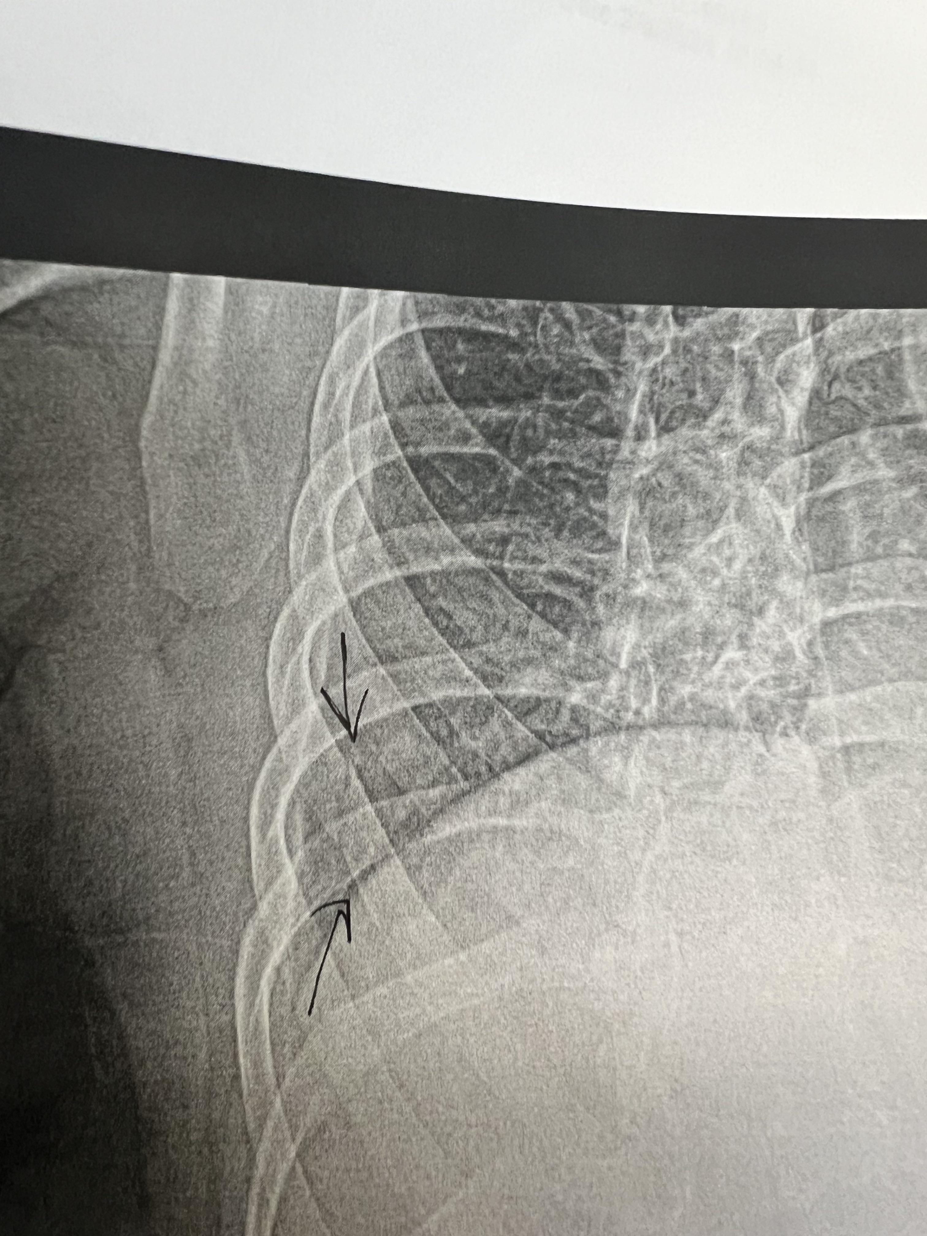 Broken rib from a coughing fit r/Radiology