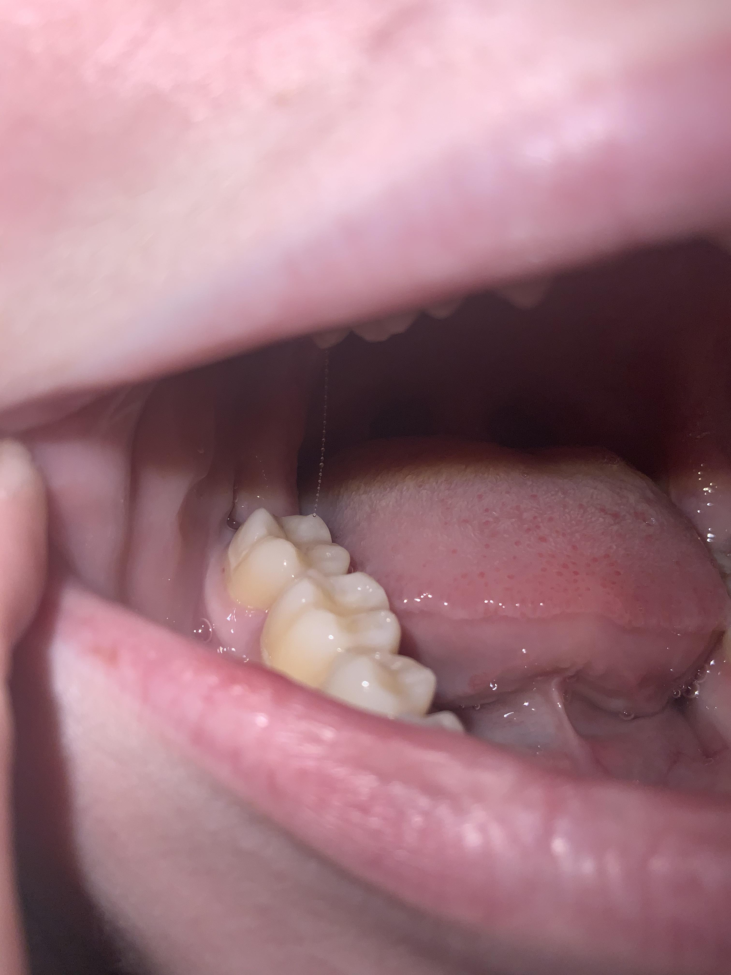 Wisdom tooth removal day 12. Does this look normal? In some