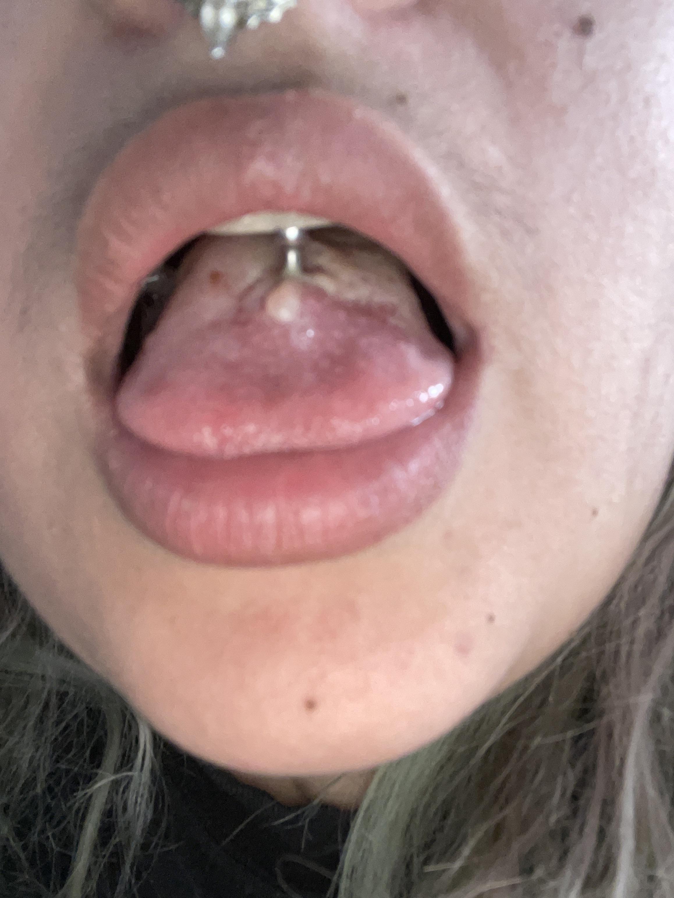I have this white bump on my tongue piercing it’s four days old should