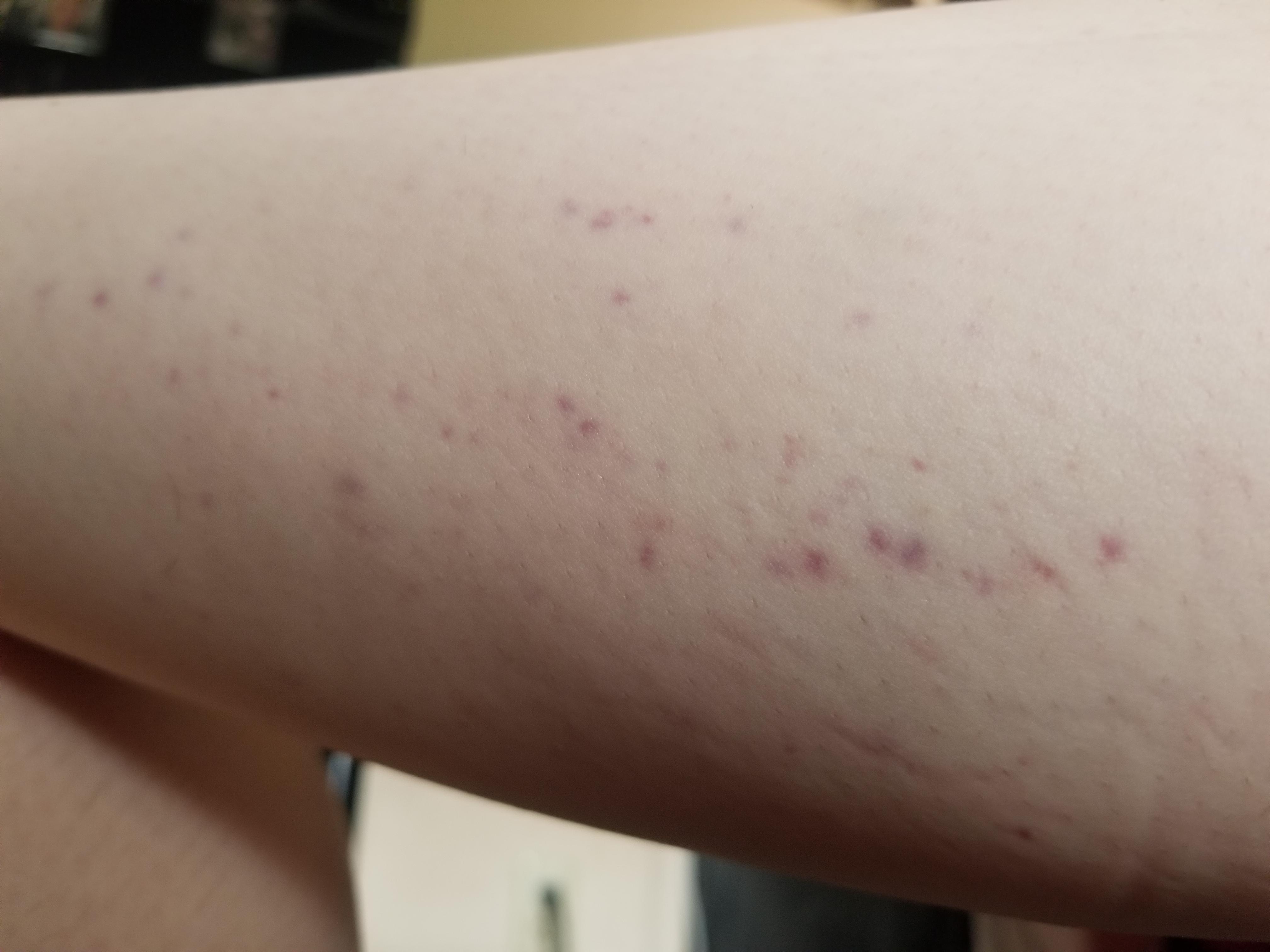 small purple spots on my leg? petechiae? r/medical_advice
