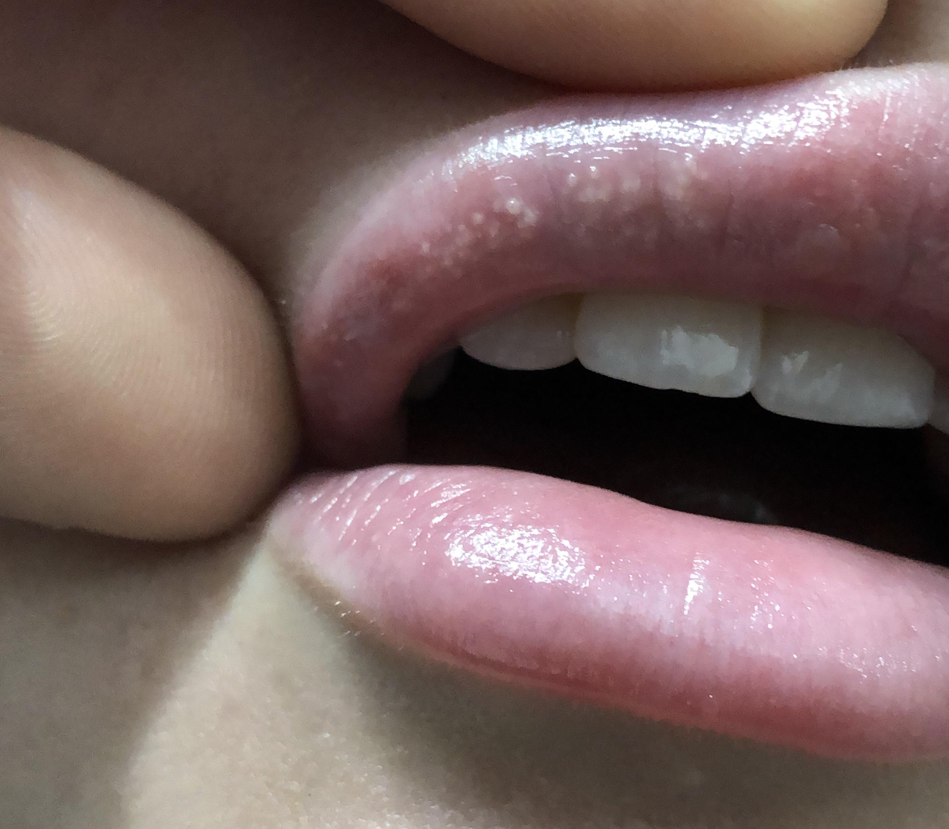 What are these little white bumps? 5 days post filler PlasticSurgery