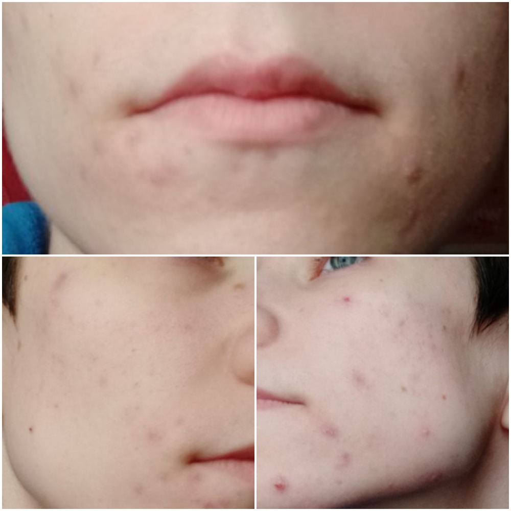 [Routine Help] How can I deal with the scarring? Scared of irritating