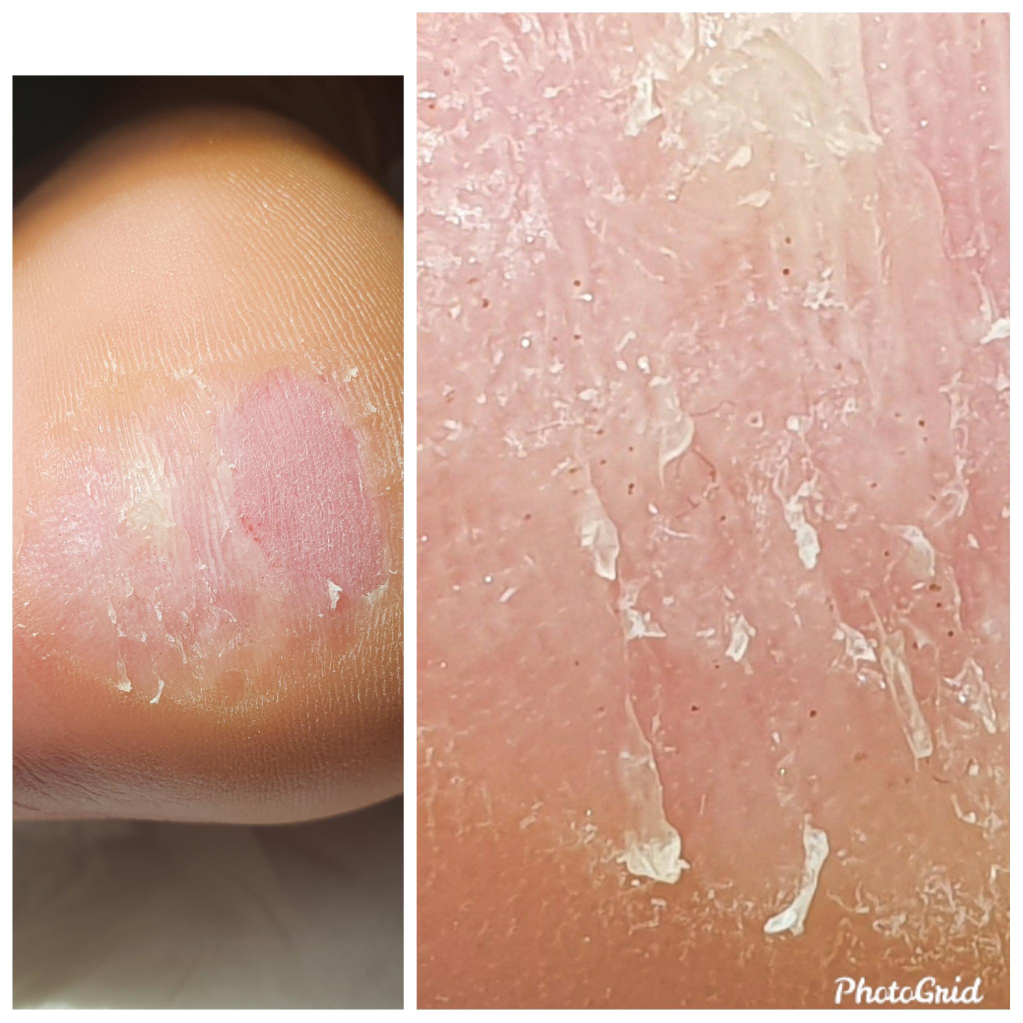 Just rubbed of a callous to find this. Wart? Warts