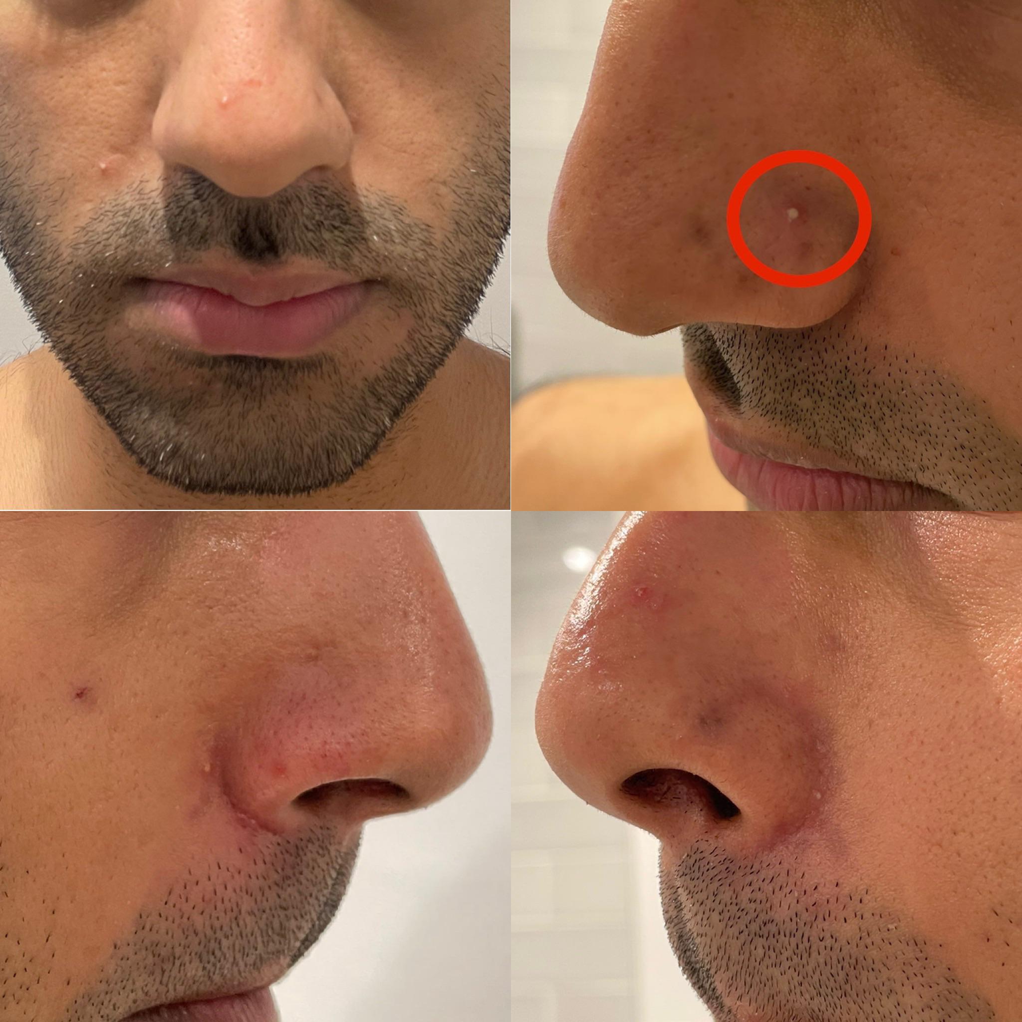 [Acne] Please help I only get white spots on my nose and nasal folds