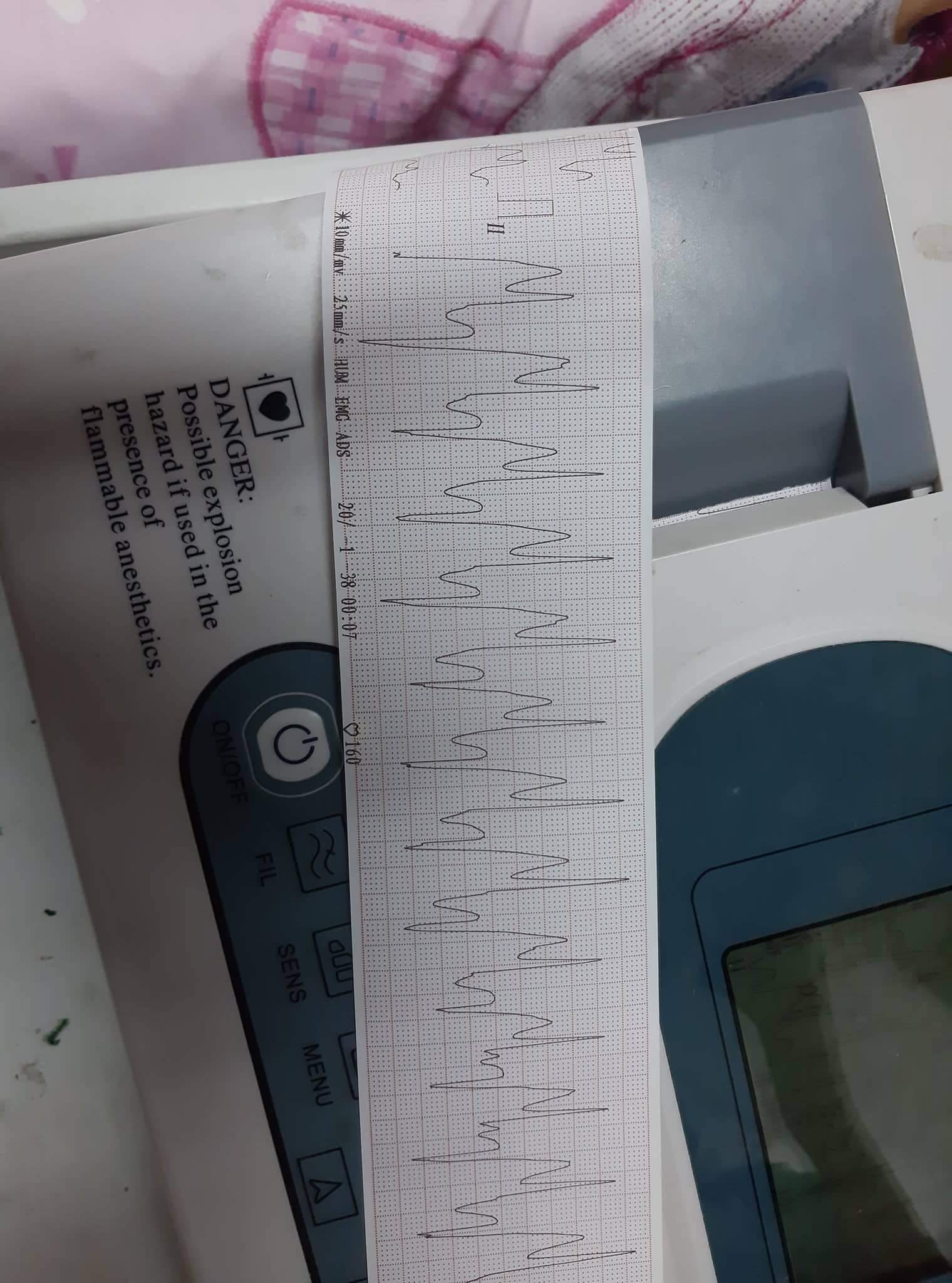 EKG of a patient, what do you think r/Cardiology