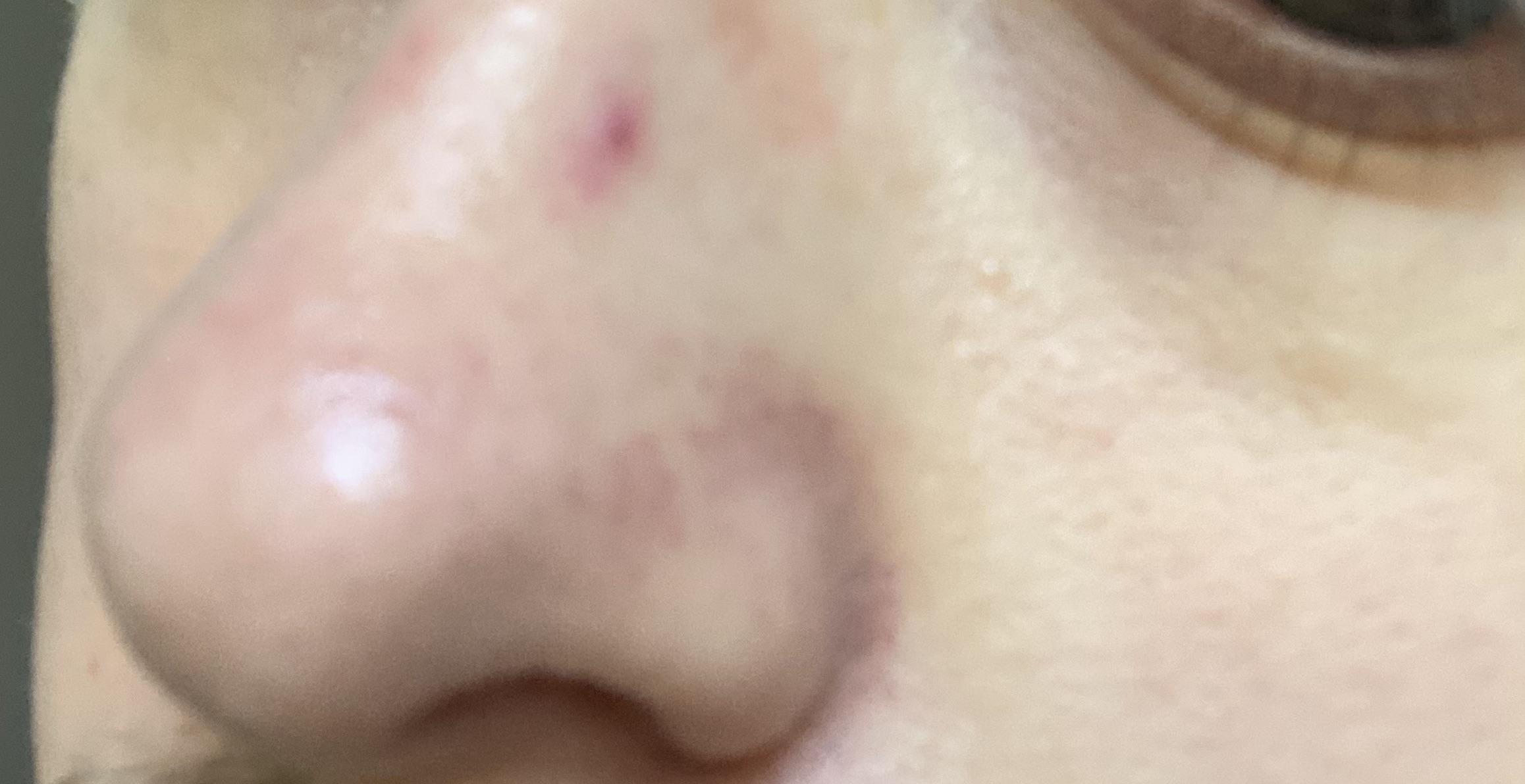 Red Mark on Nose, it’s been there for a long time, won’t go away