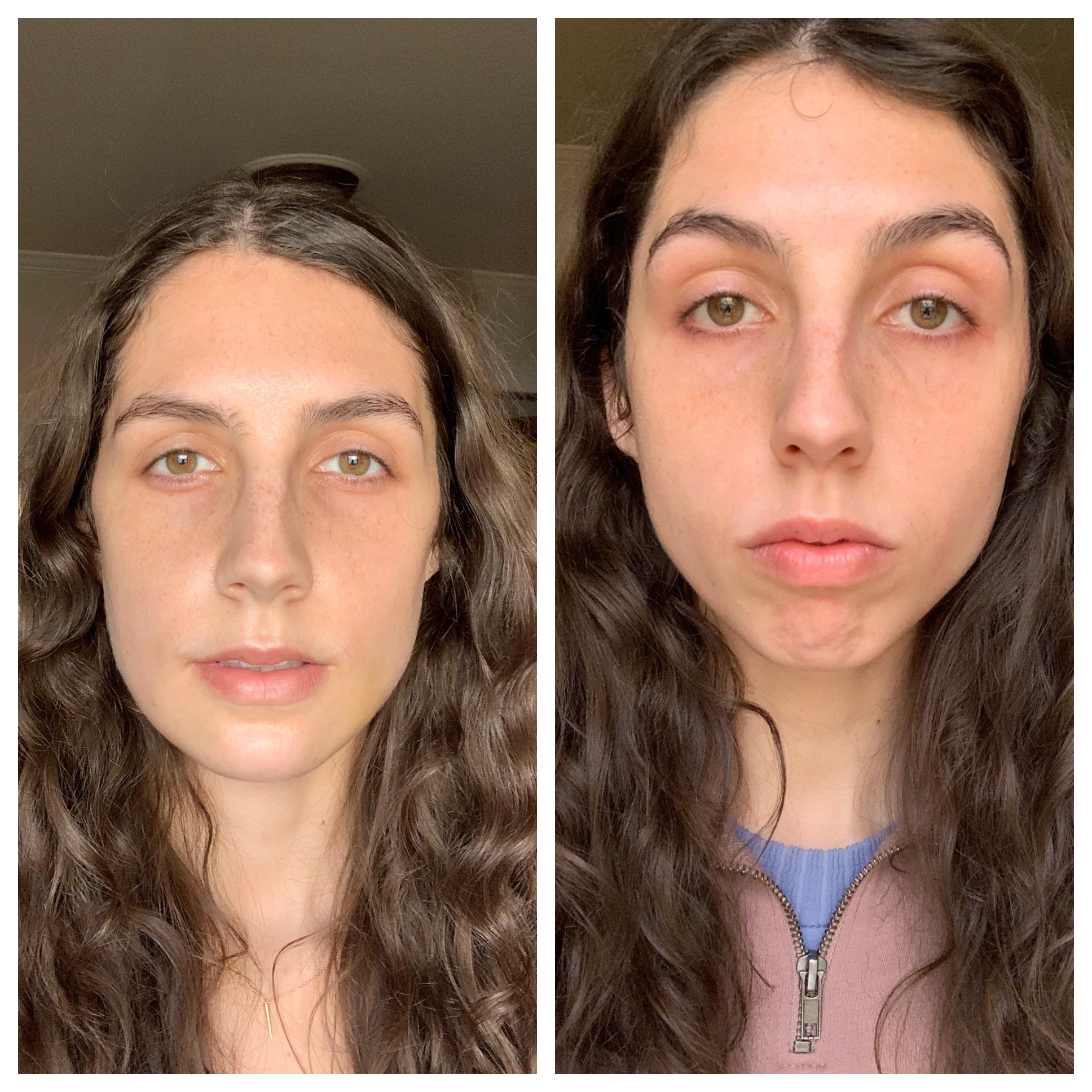 Do you need to wear braces before jaw surgery or is I dependent on your