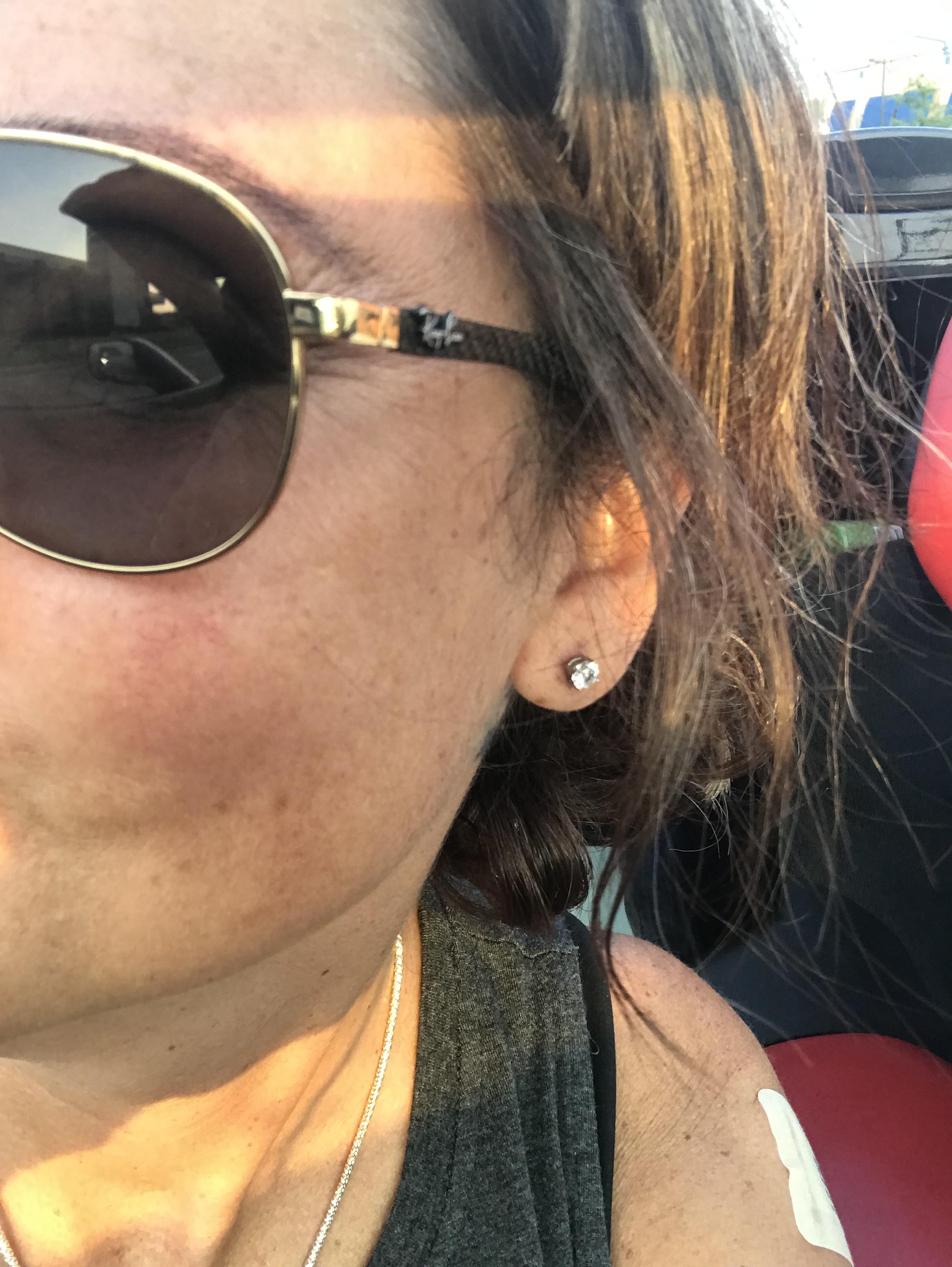 Been waiting YEARS because of old keloids from gun piercing at 6. 46th