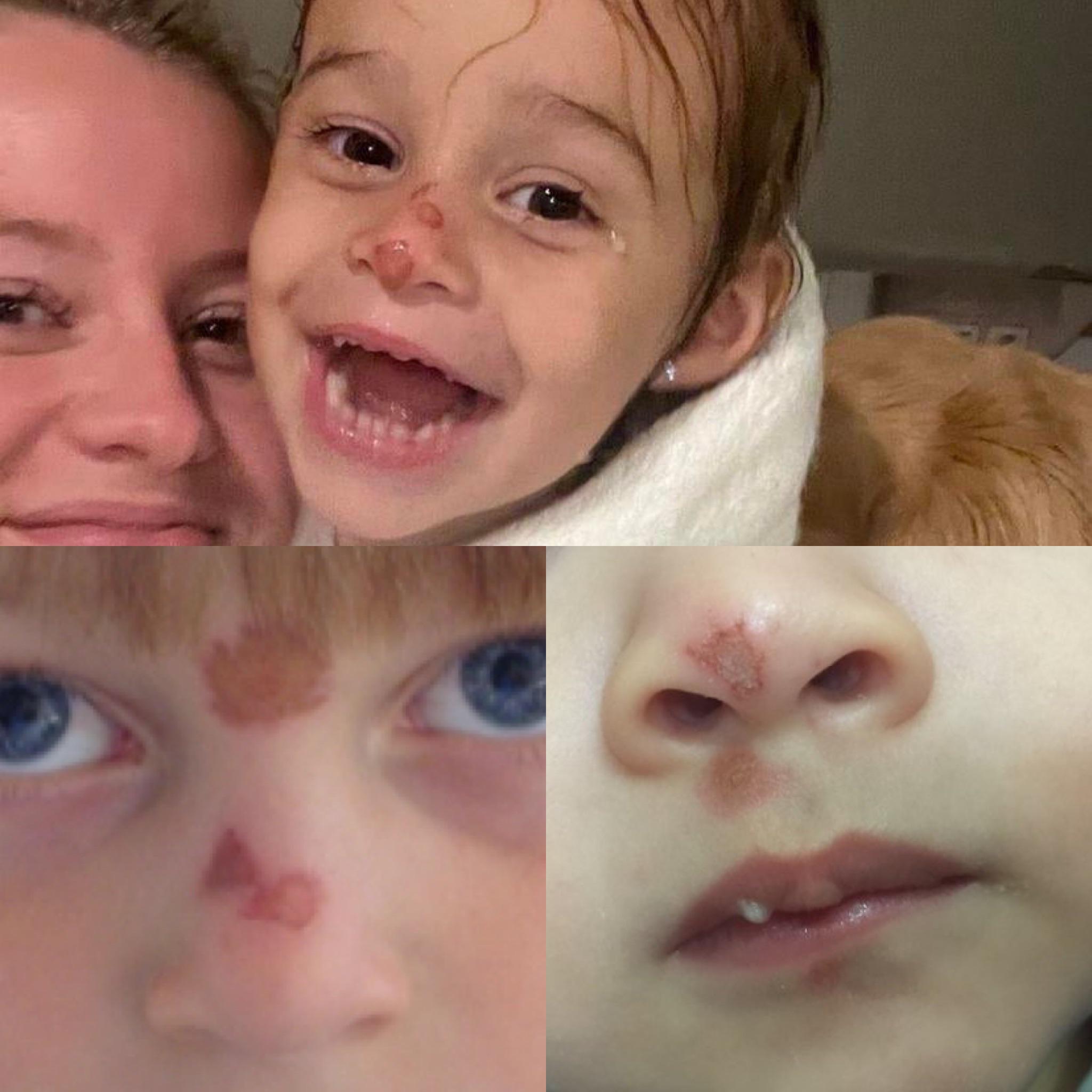 i googled rug burn on kids and it does look like that's what Emmy has